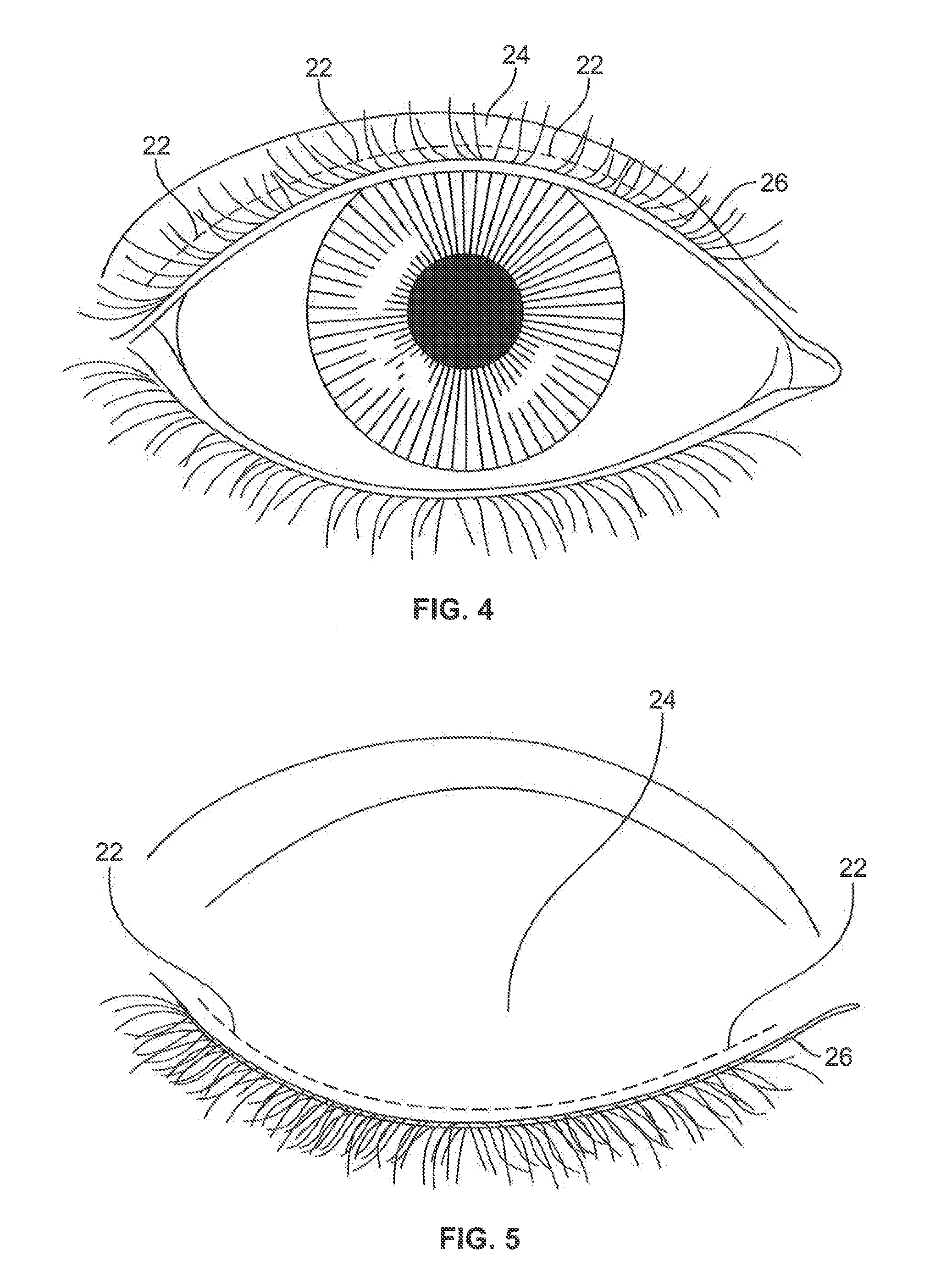 Ciliary implant, ciliary augmentation