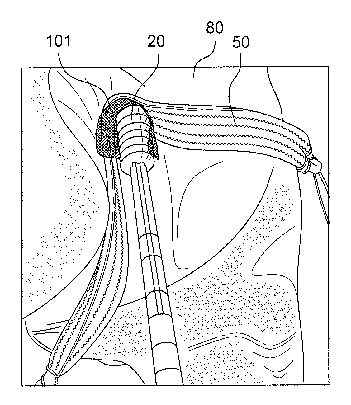 Graft protection mesh and fixation technique