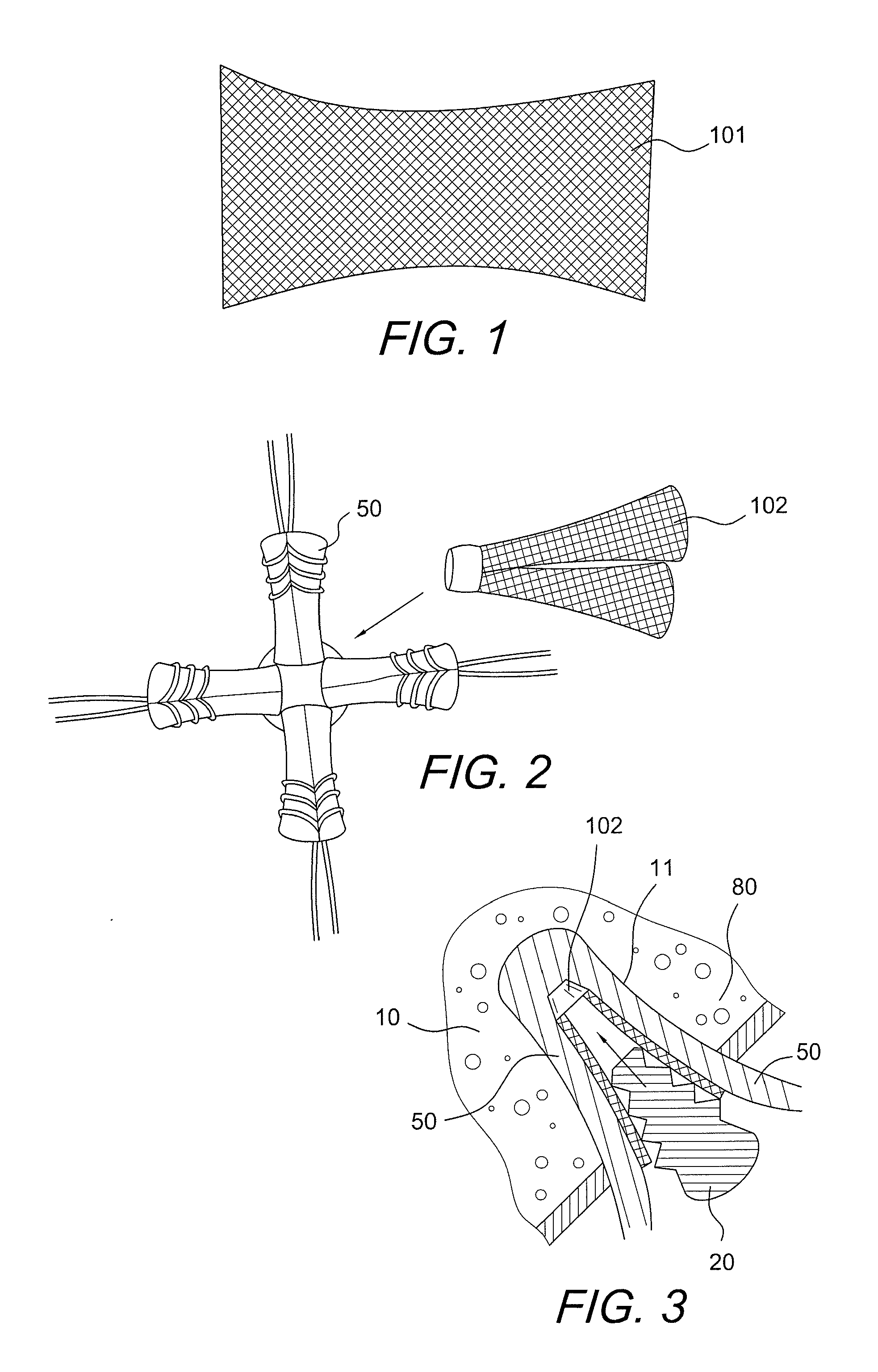 Graft protection mesh and fixation technique