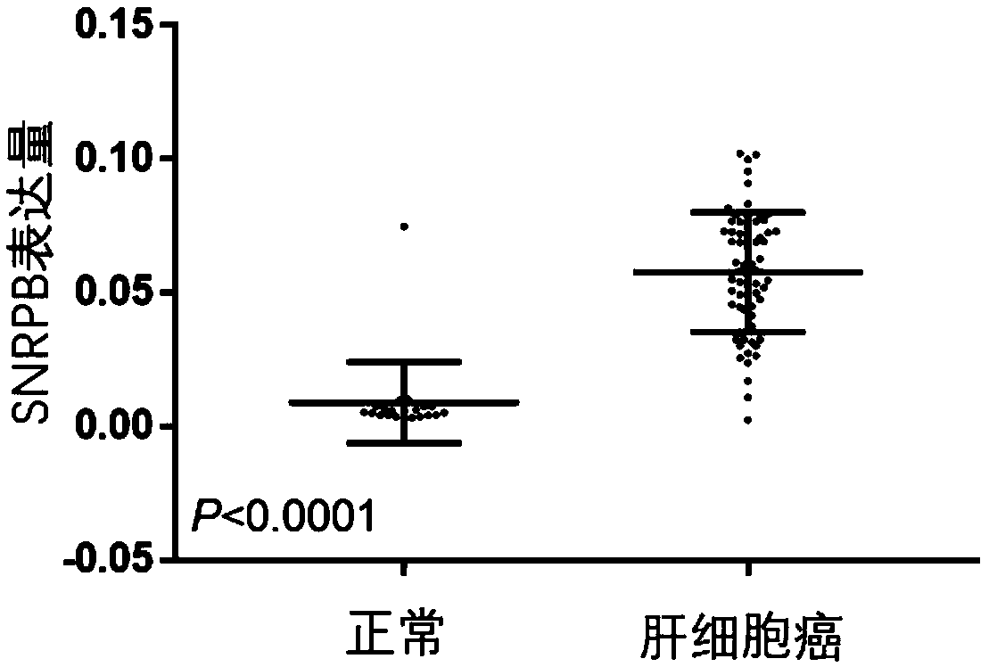 Application of SNRPB as biomarker in prognosis evaluation of hepatocellular carcinoma and kit containing biomarker