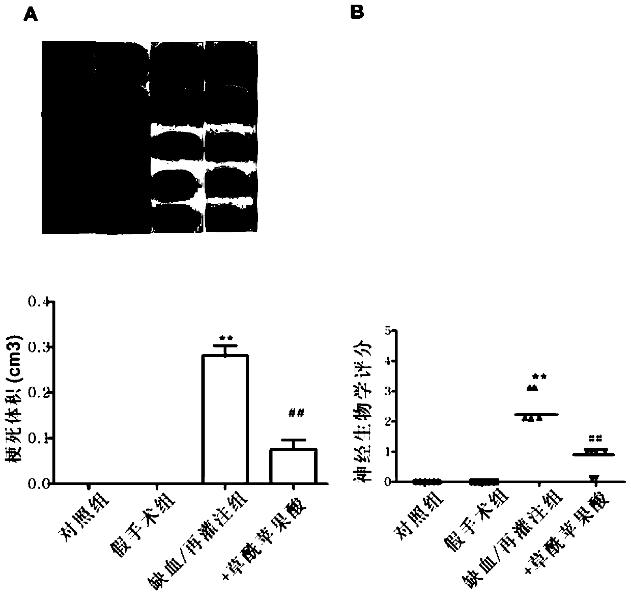 Application of oxalomalic acid in preparation of drugs to treat nerve cell damage