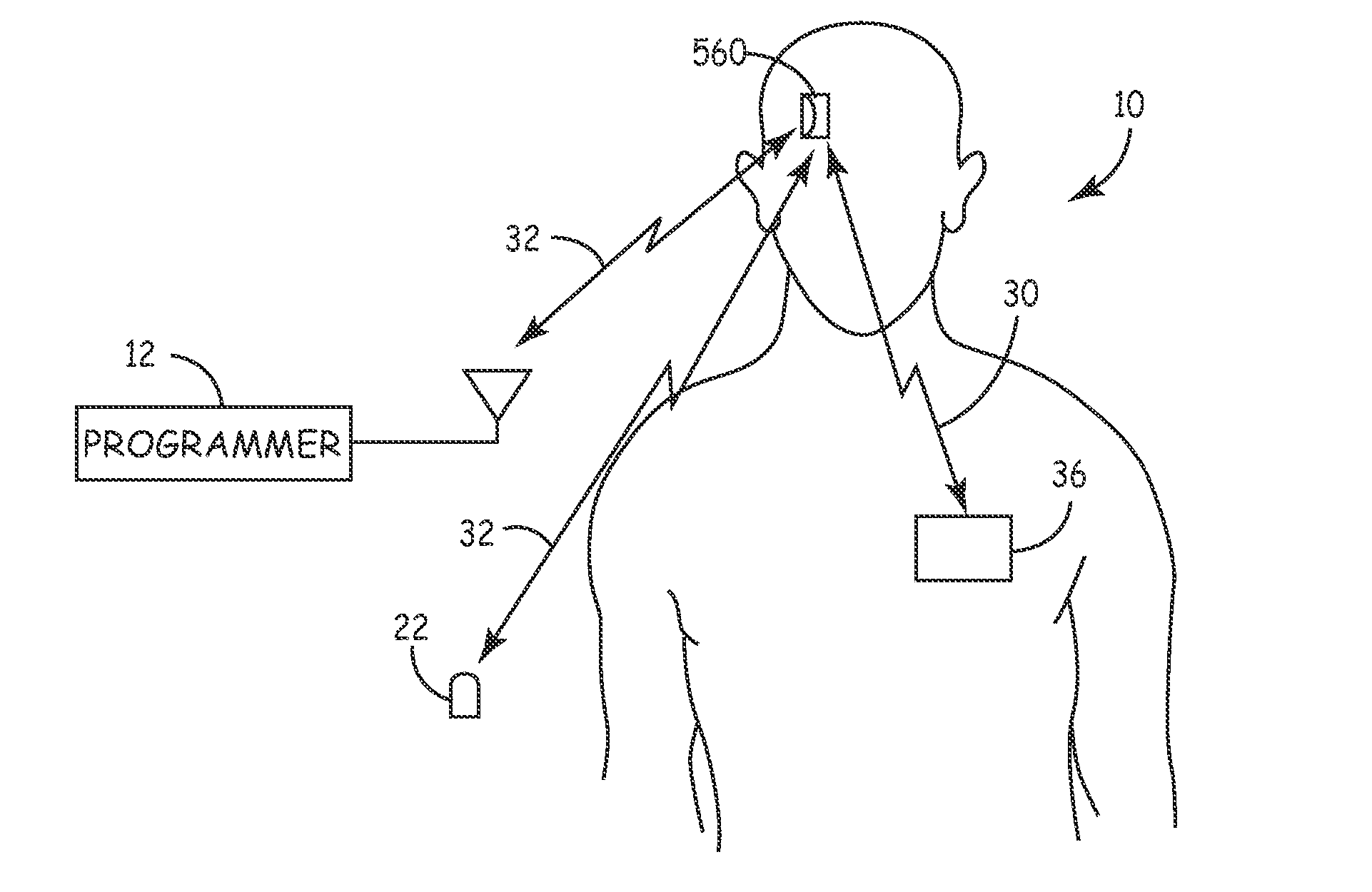 System and method for segmenting a cardiac signal based on brain activity