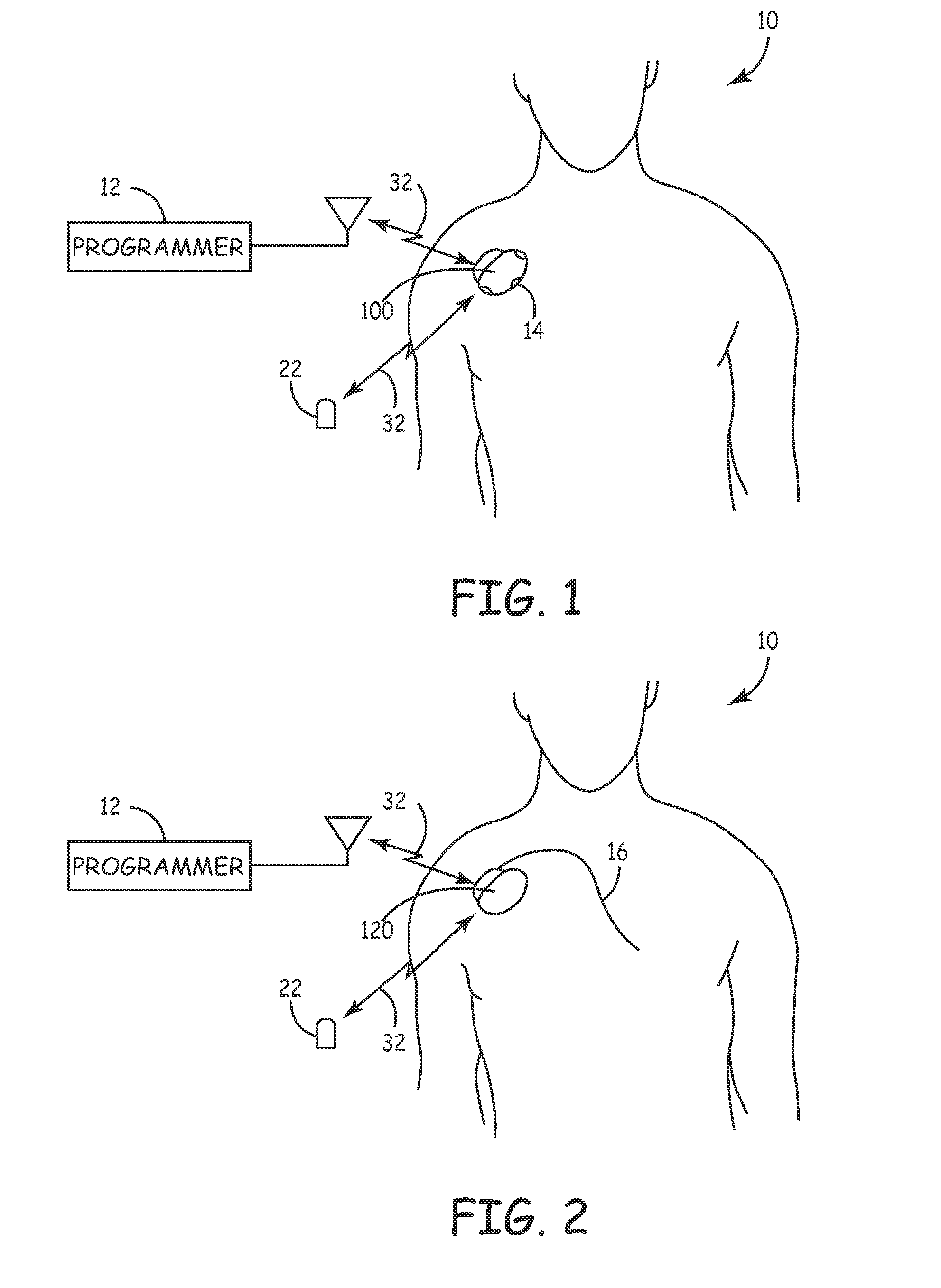 System and method for segmenting a cardiac signal based on brain activity