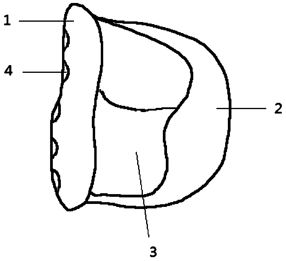 A personalized temporomandibular joint socket prosthesis