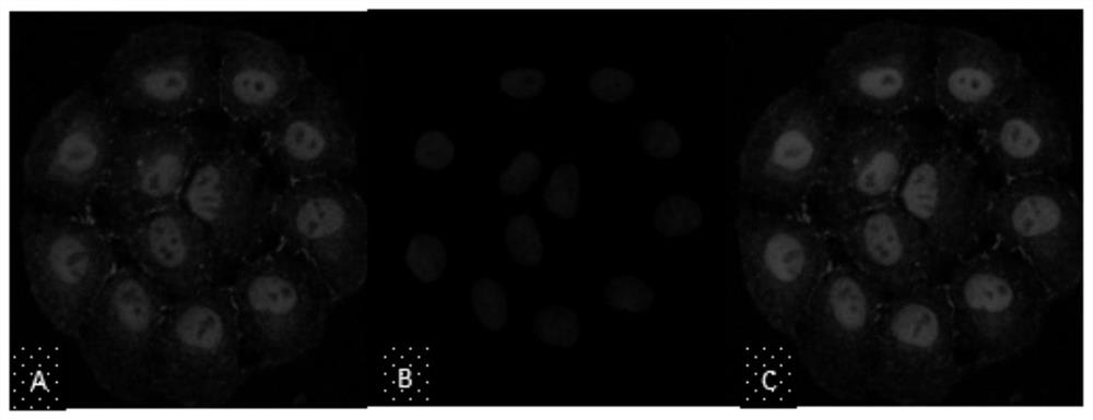 Application of sglt2 inhibitor in the preparation of reagents for inhibiting glucose absorption by pmcs or peritoneal fibrosis