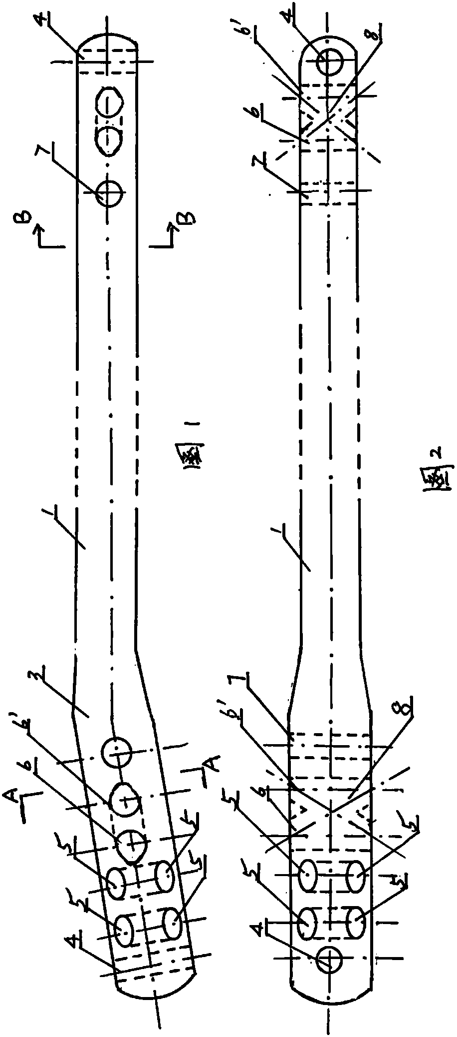 Locking Multidirectional Locking Intramedullary Nail