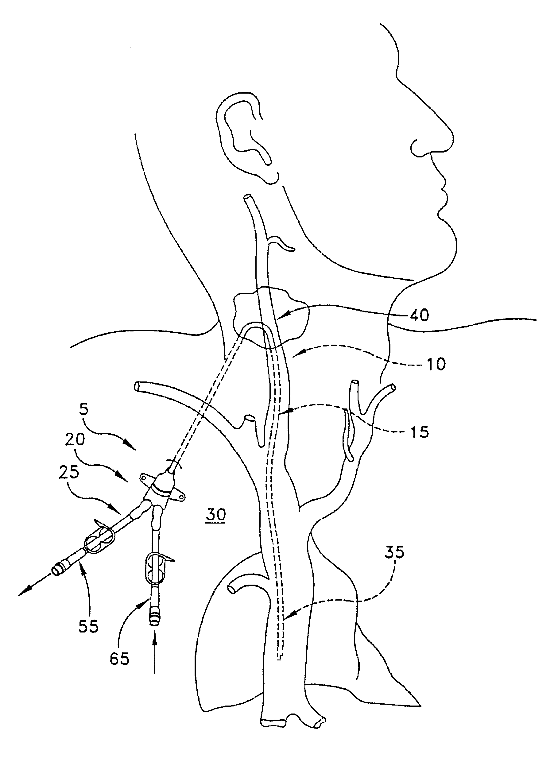 Method and apparatus for the dialysis of blood