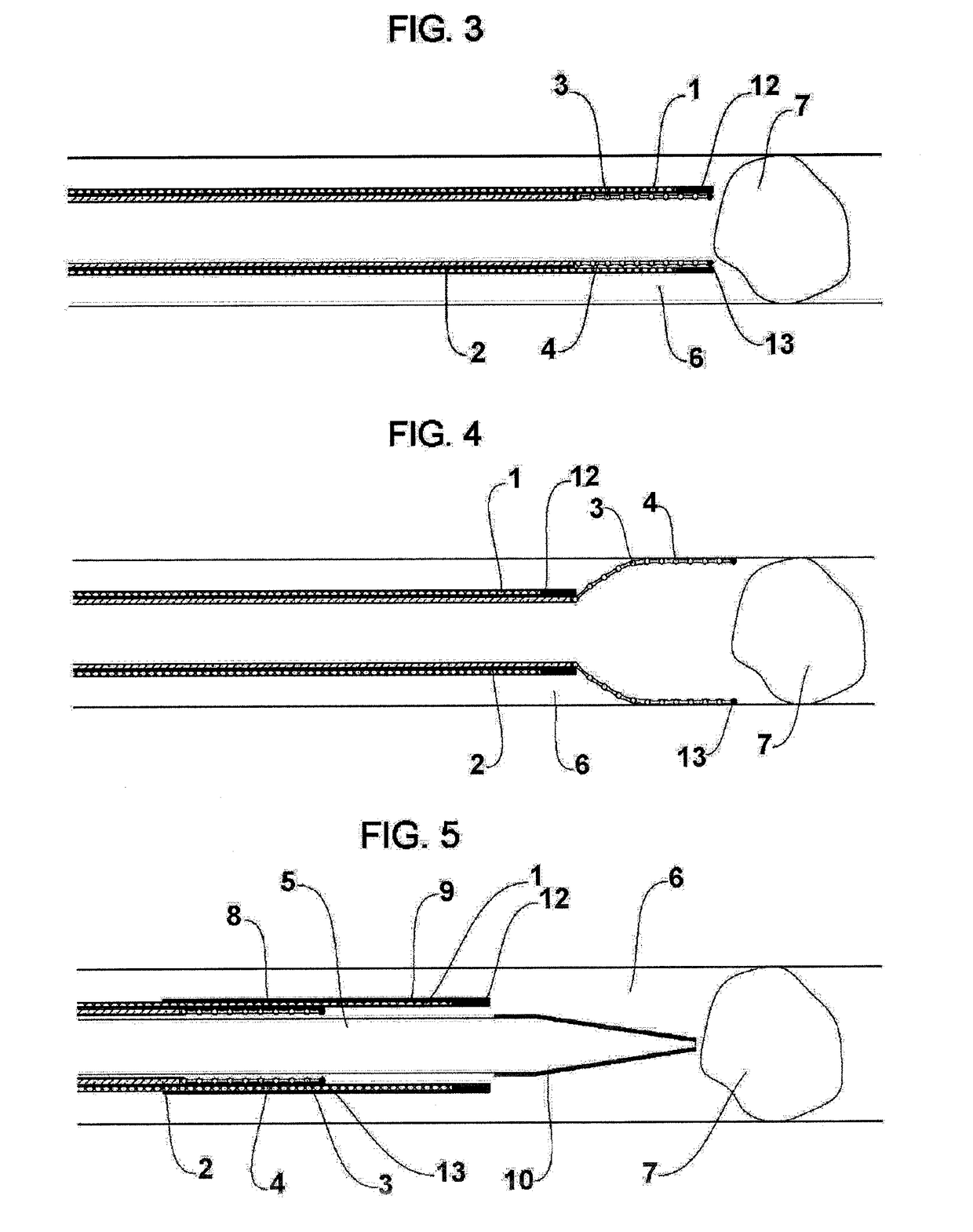 Thrombectomy device, system and method for extraction of vascular thrombi from a blood vessel