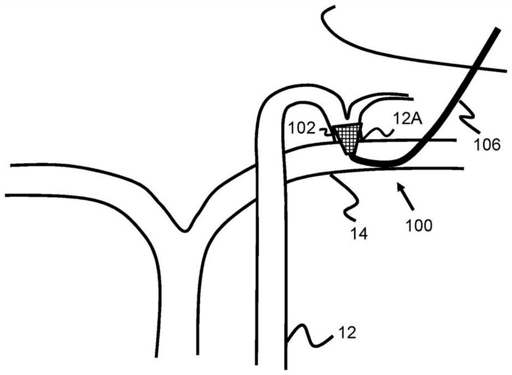 System and method for treatment via bodily drainage or injection