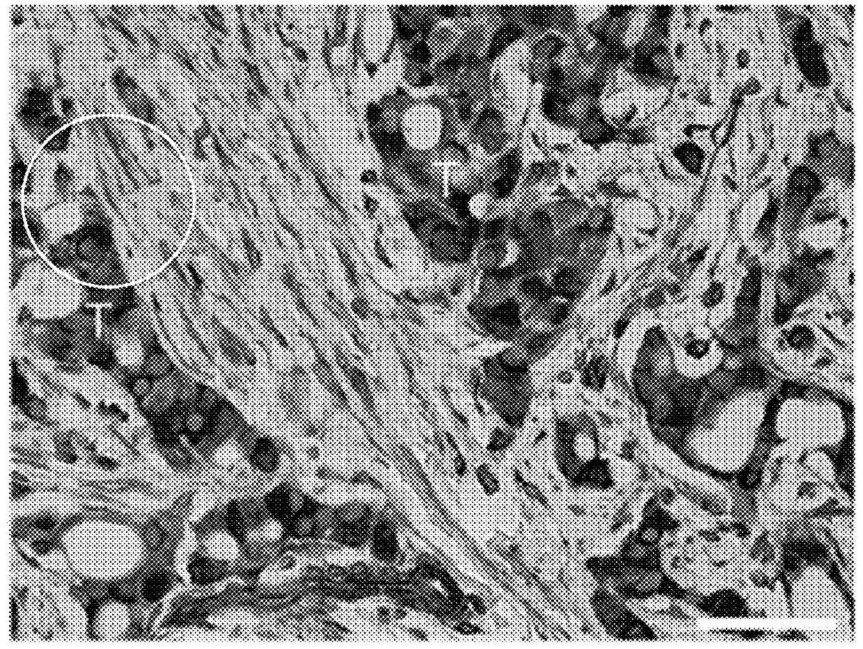 Targeting breast cancer therapy based on stromal subtypes and cd146 composition