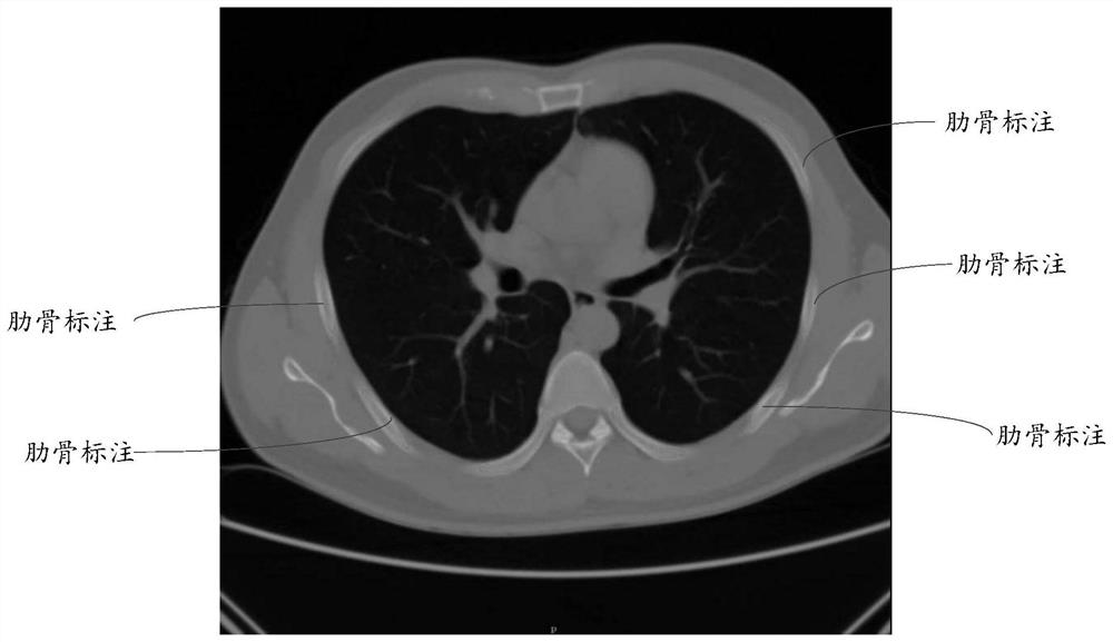 CT rib fracture auxiliary diagnosis system based on deep learning algorithm