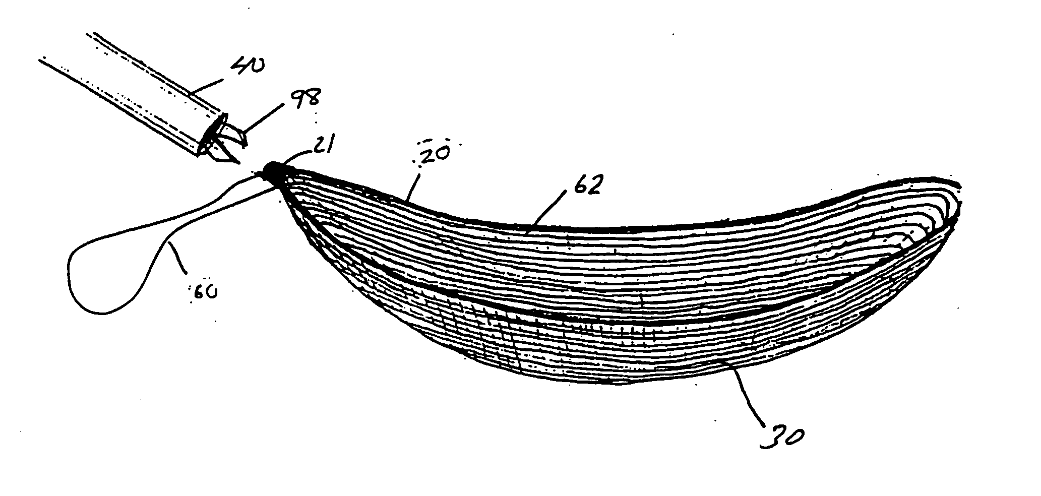 Laparoscopic stone safety device and method