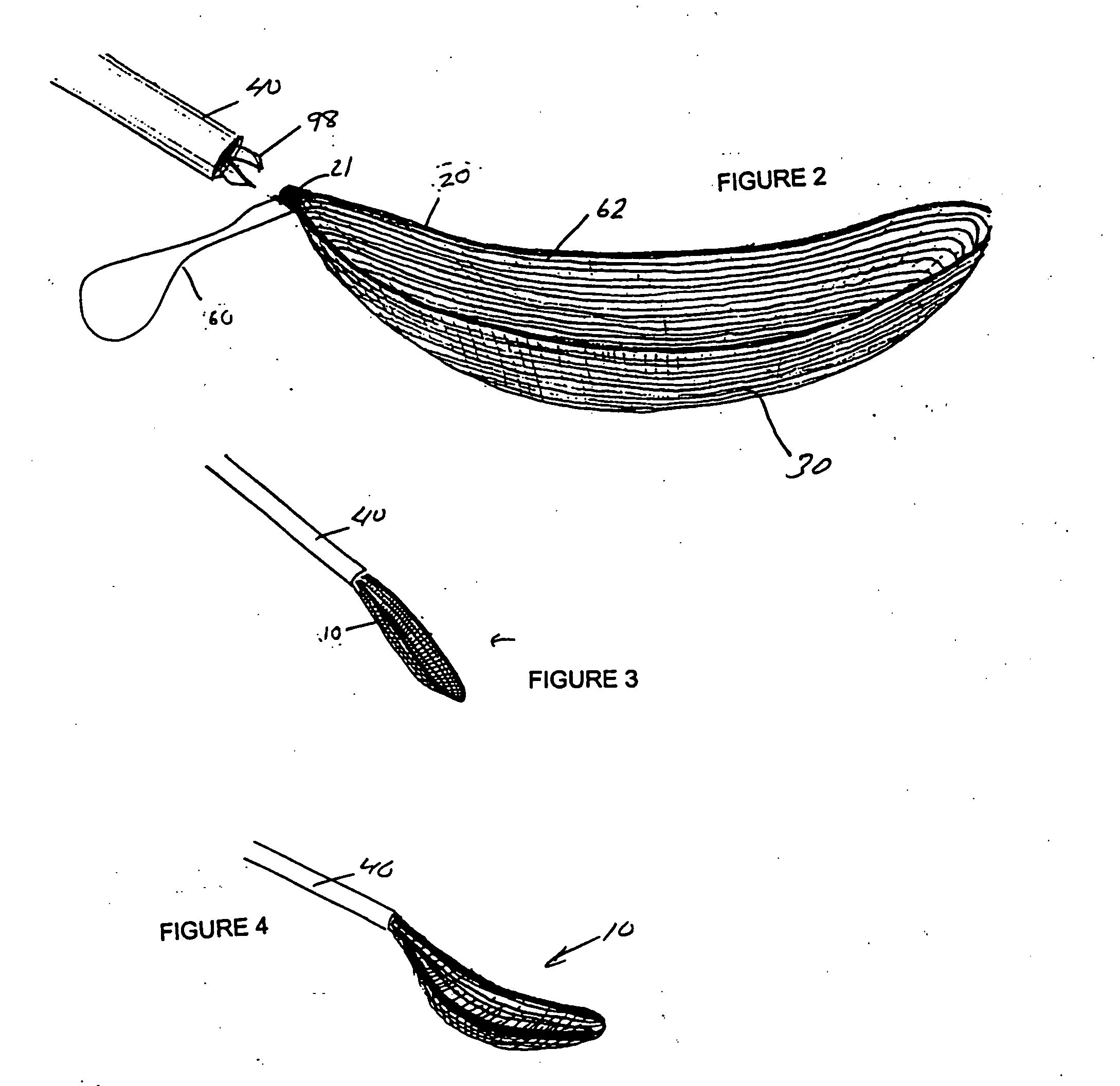 Laparoscopic stone safety device and method