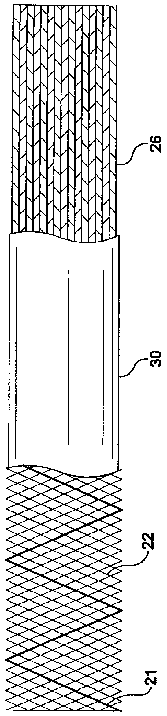 Stent-graft-membrane and method of making the same