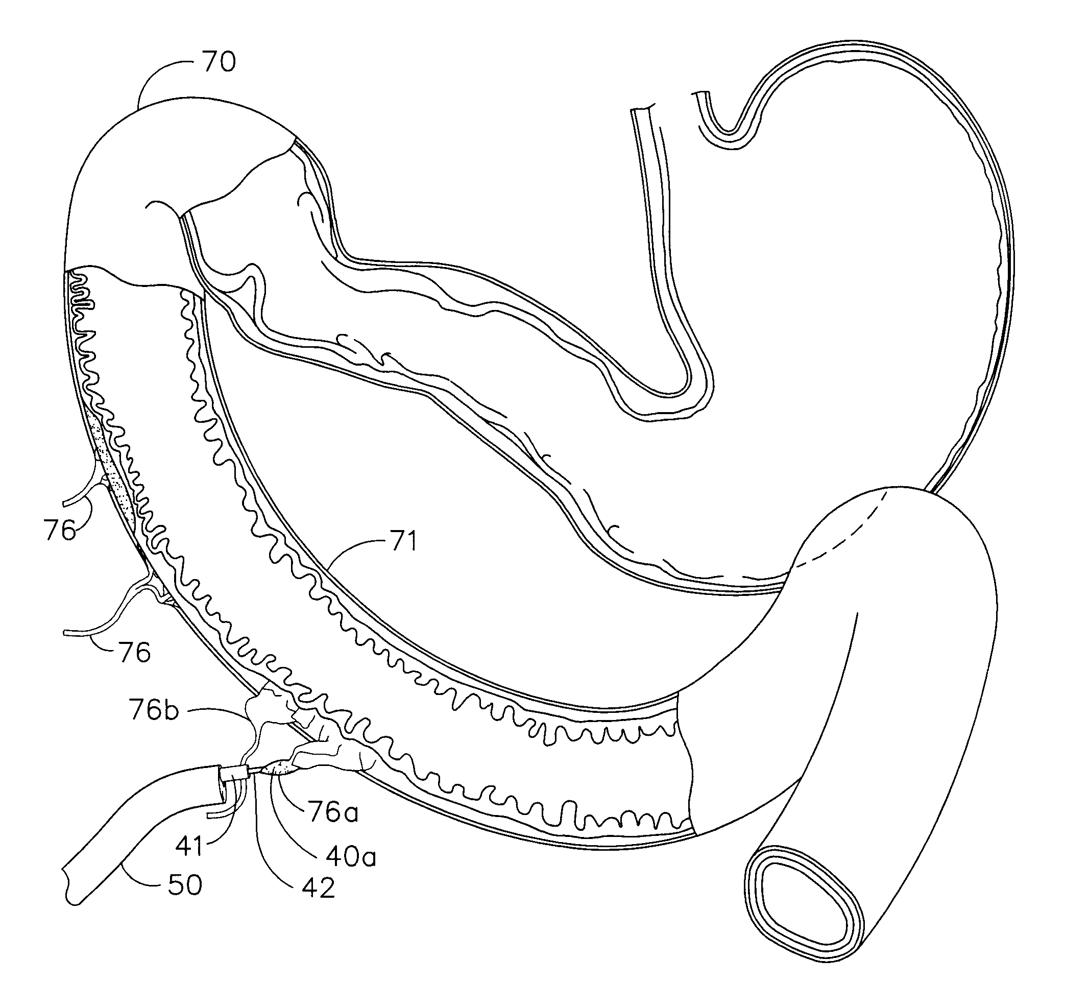 Use of an adhesive as an intestinal barrier for bariatrics