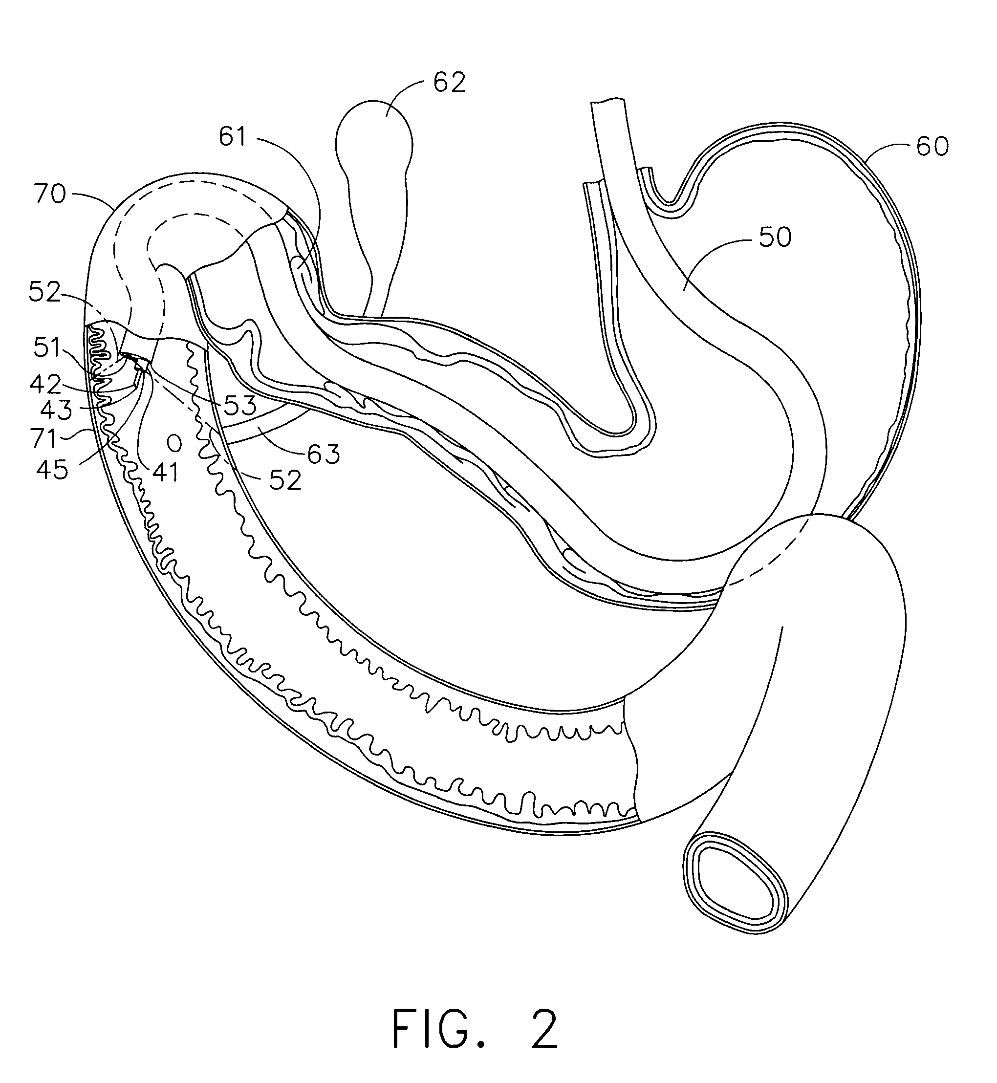 Use of an adhesive as an intestinal barrier for bariatrics