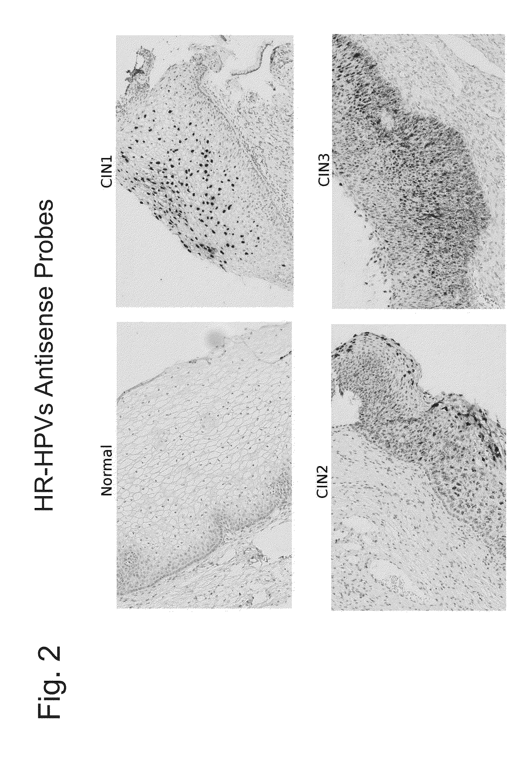 Differentiation between transient and persistent high-risk HPV infection by in situ hybridization