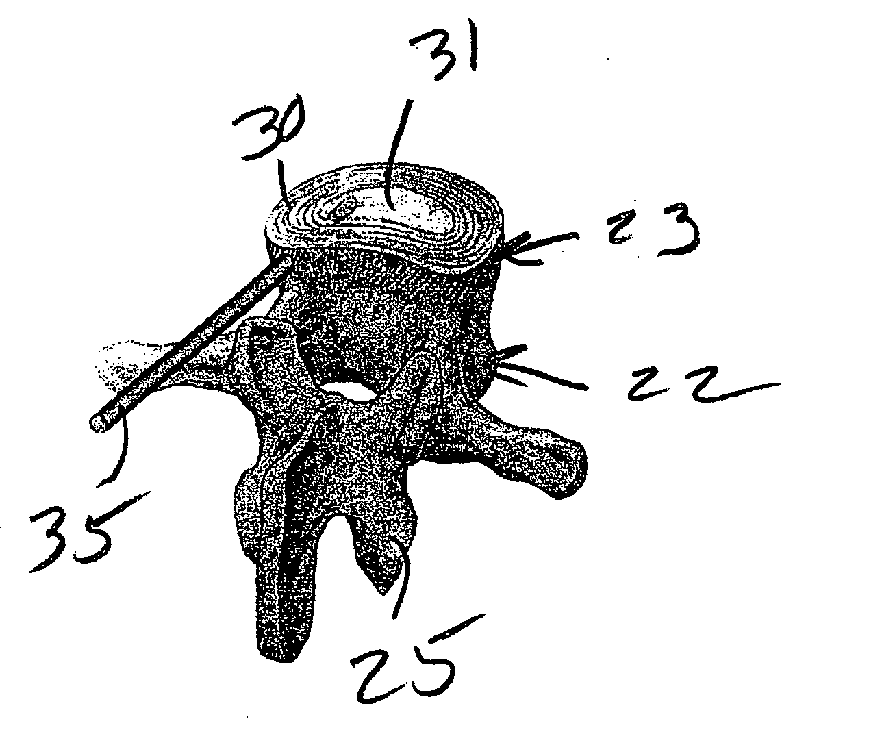 Method and composition for repair and reconstruction of intervertebral discs and other reconstructive surgery