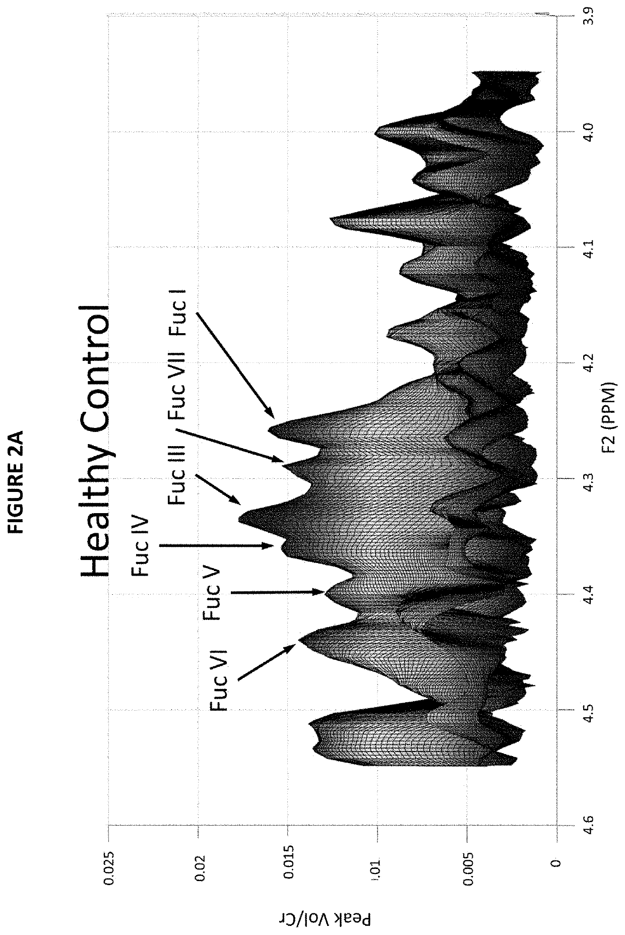 Method and system for monitoring the progress of treatment of an individual having acute pain, chronic pain, acute stress disorder, blast exposure or ptsd using spectral data of the brain