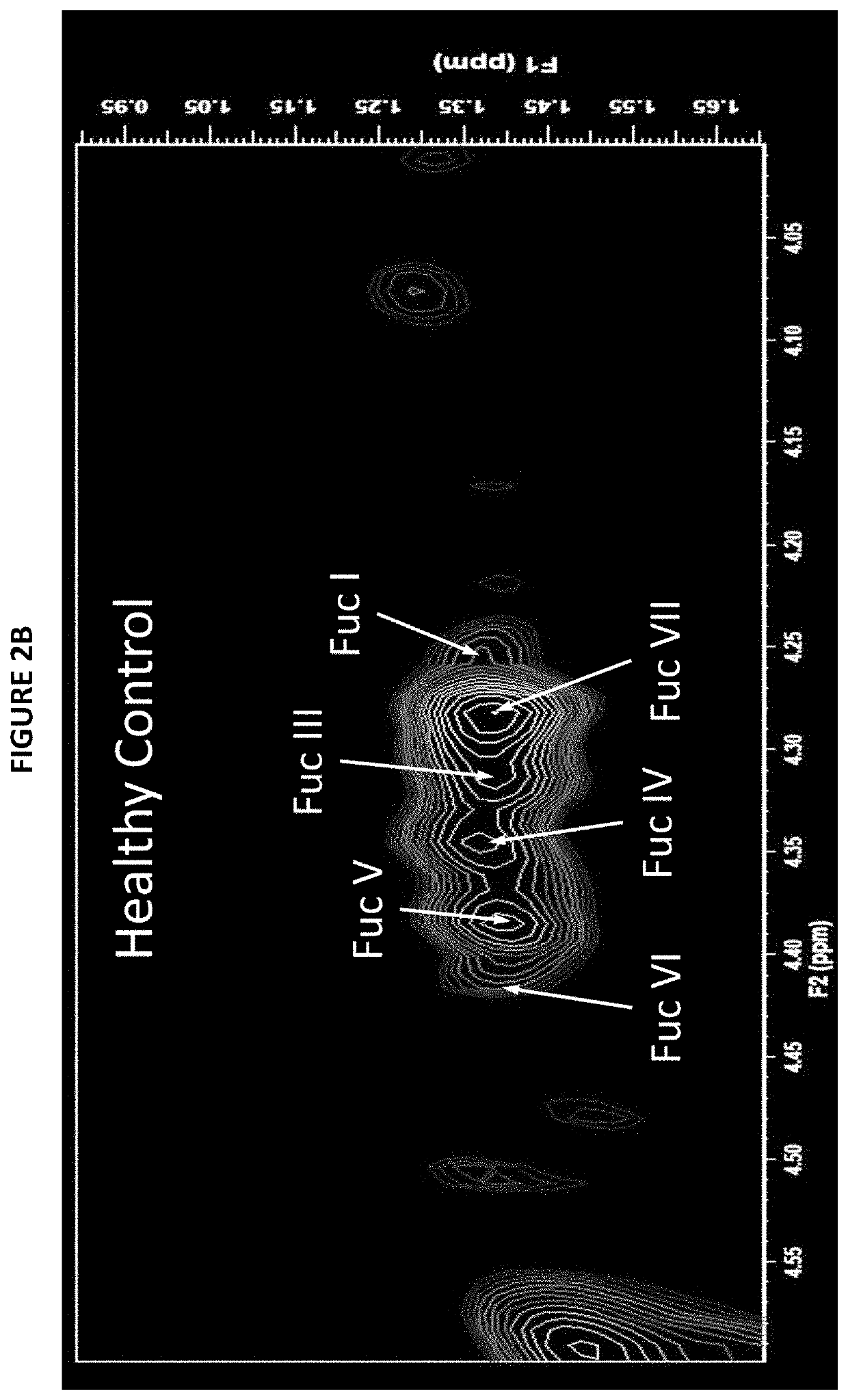 Method and system for monitoring the progress of treatment of an individual having acute pain, chronic pain, acute stress disorder, blast exposure or ptsd using spectral data of the brain