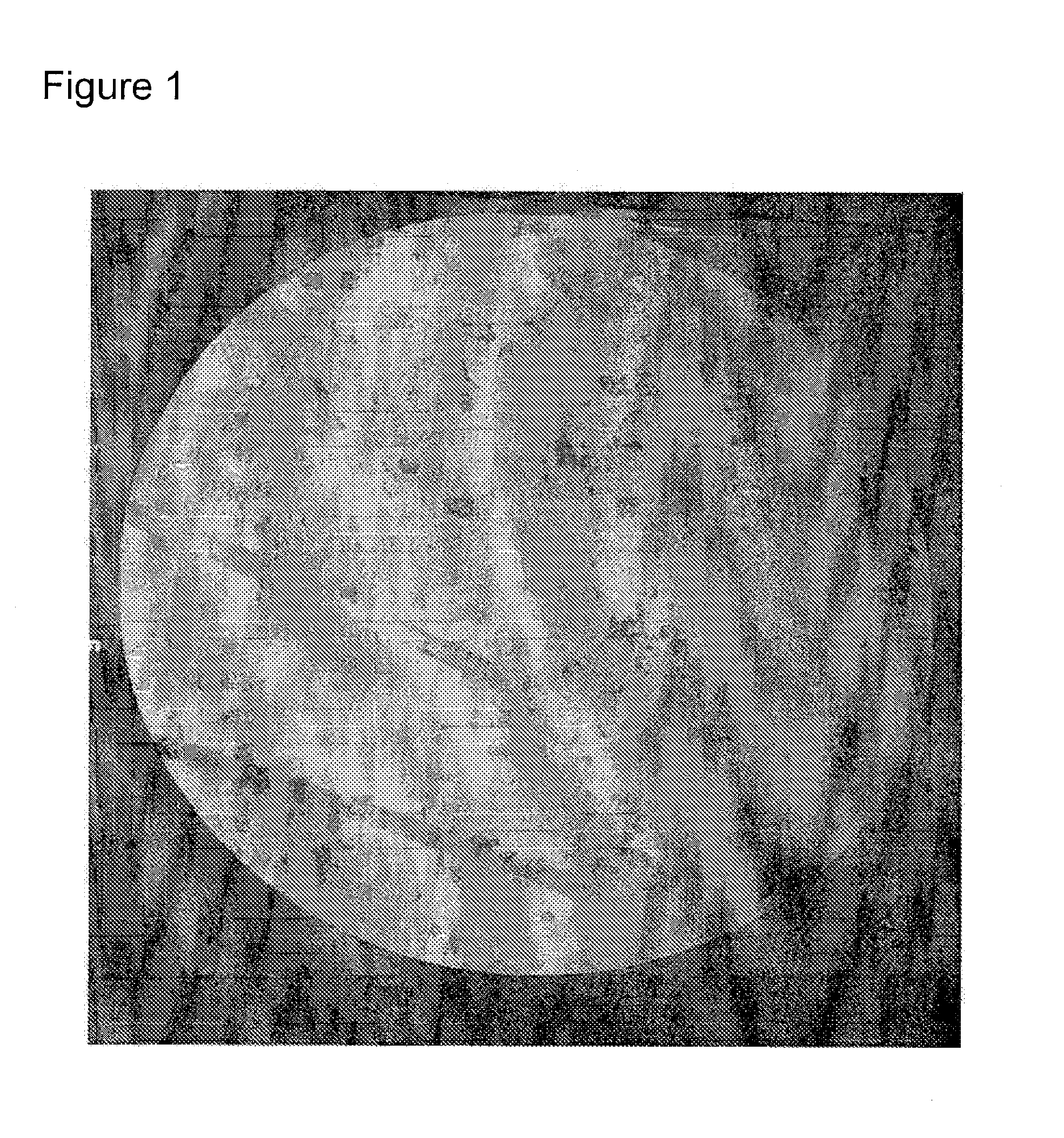 Minimally invasive treatment of vertebra (MITV) using a calcium phosphate combination bone cement