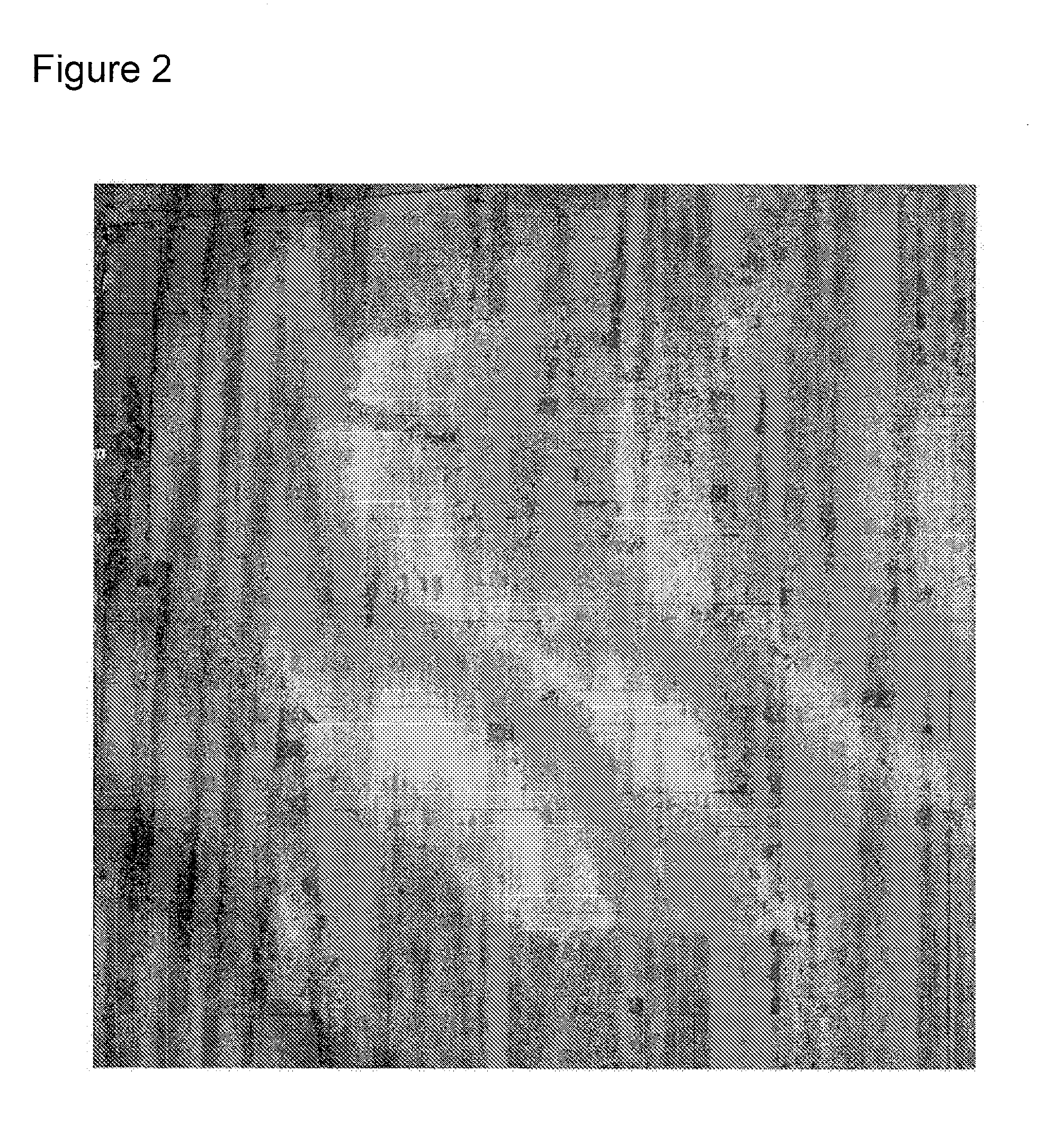 Minimally invasive treatment of vertebra (MITV) using a calcium phosphate combination bone cement