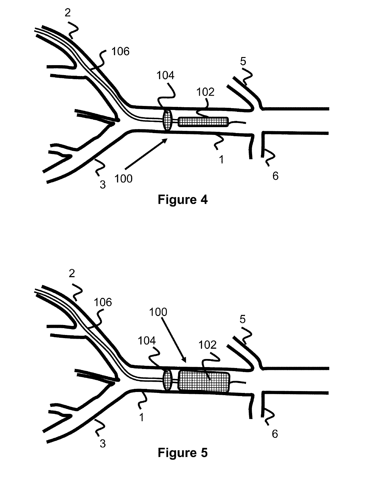 Temporary Aortic Occlusion Device