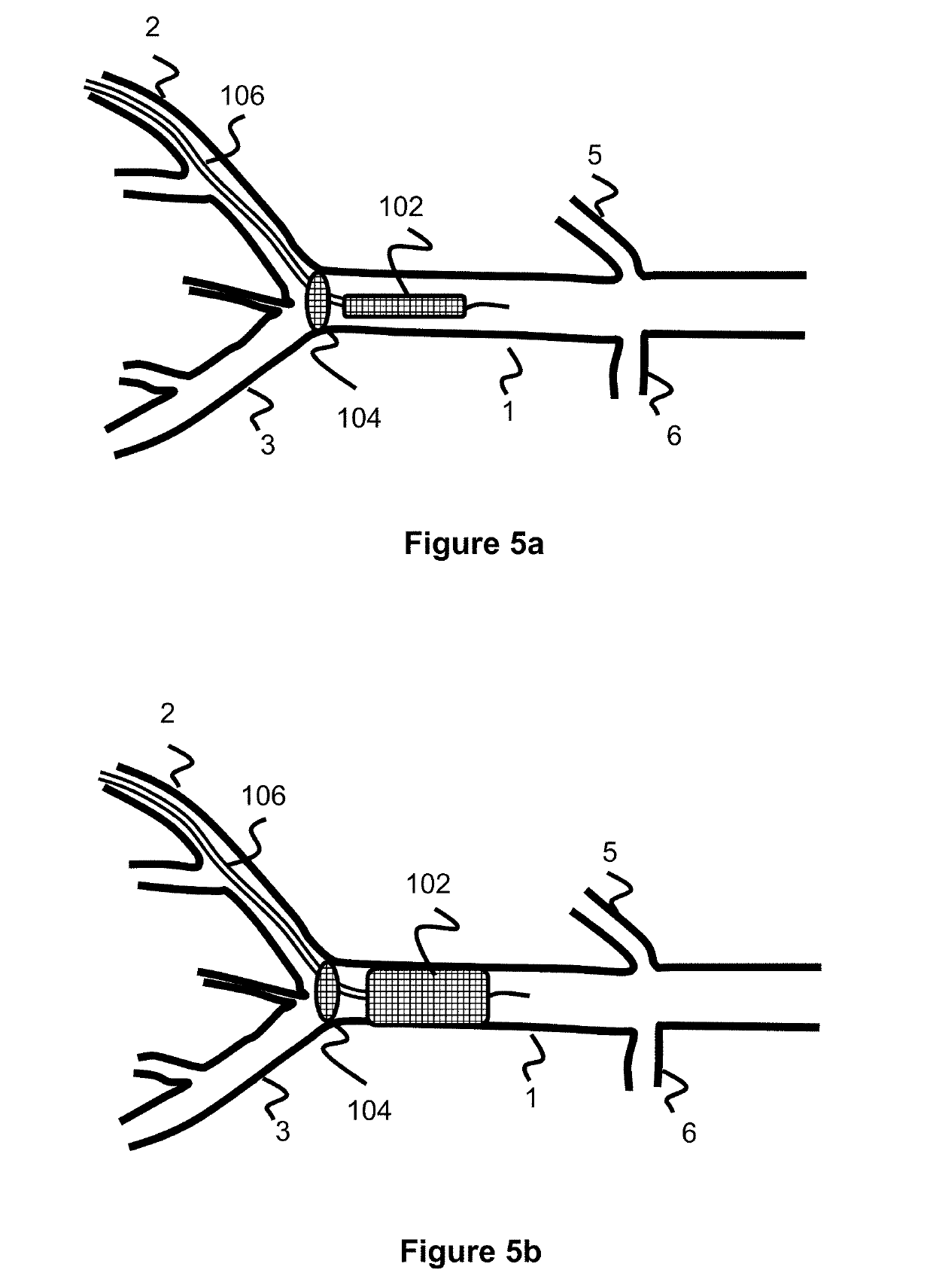 Temporary Aortic Occlusion Device