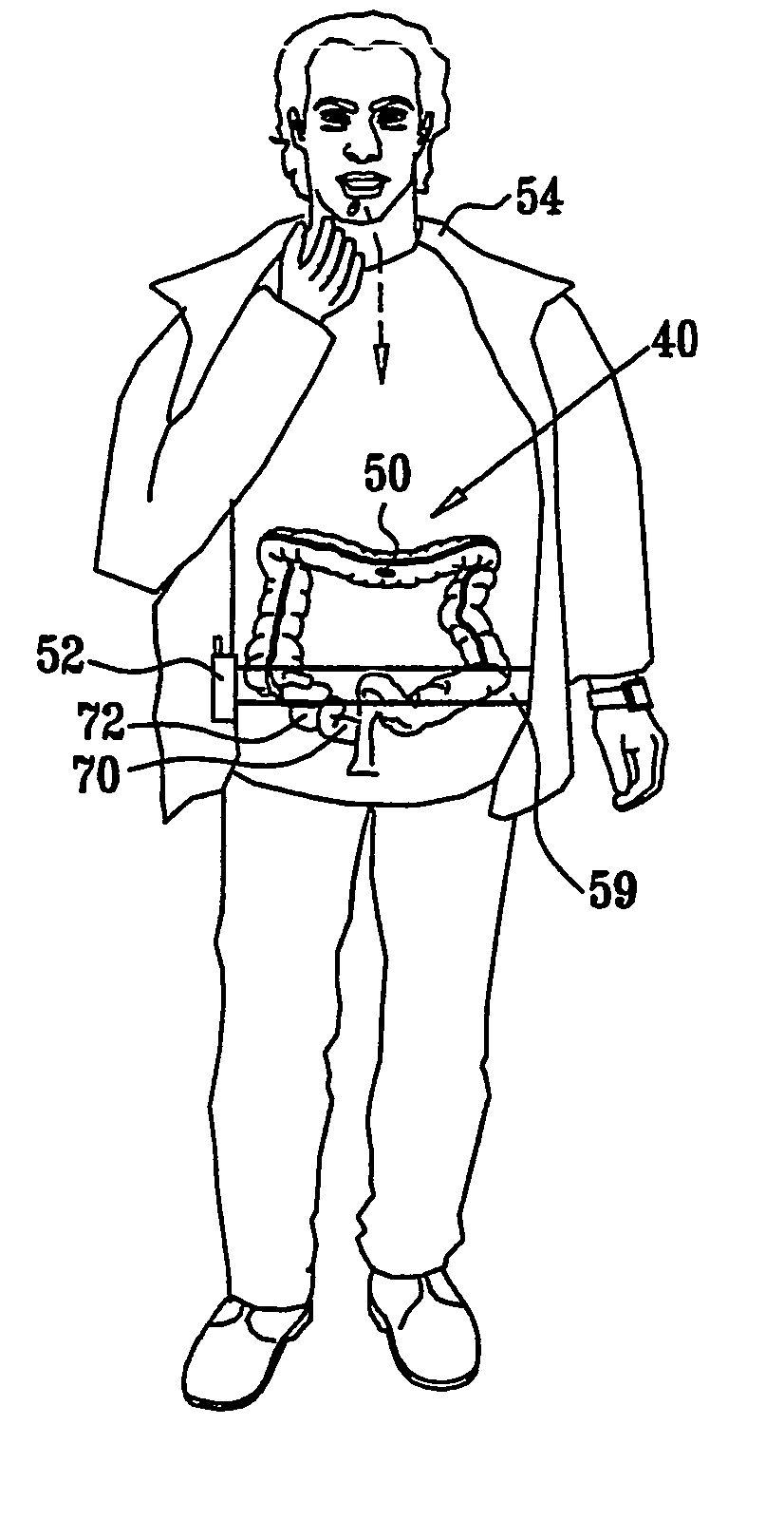 Intra-lumen polyp detection