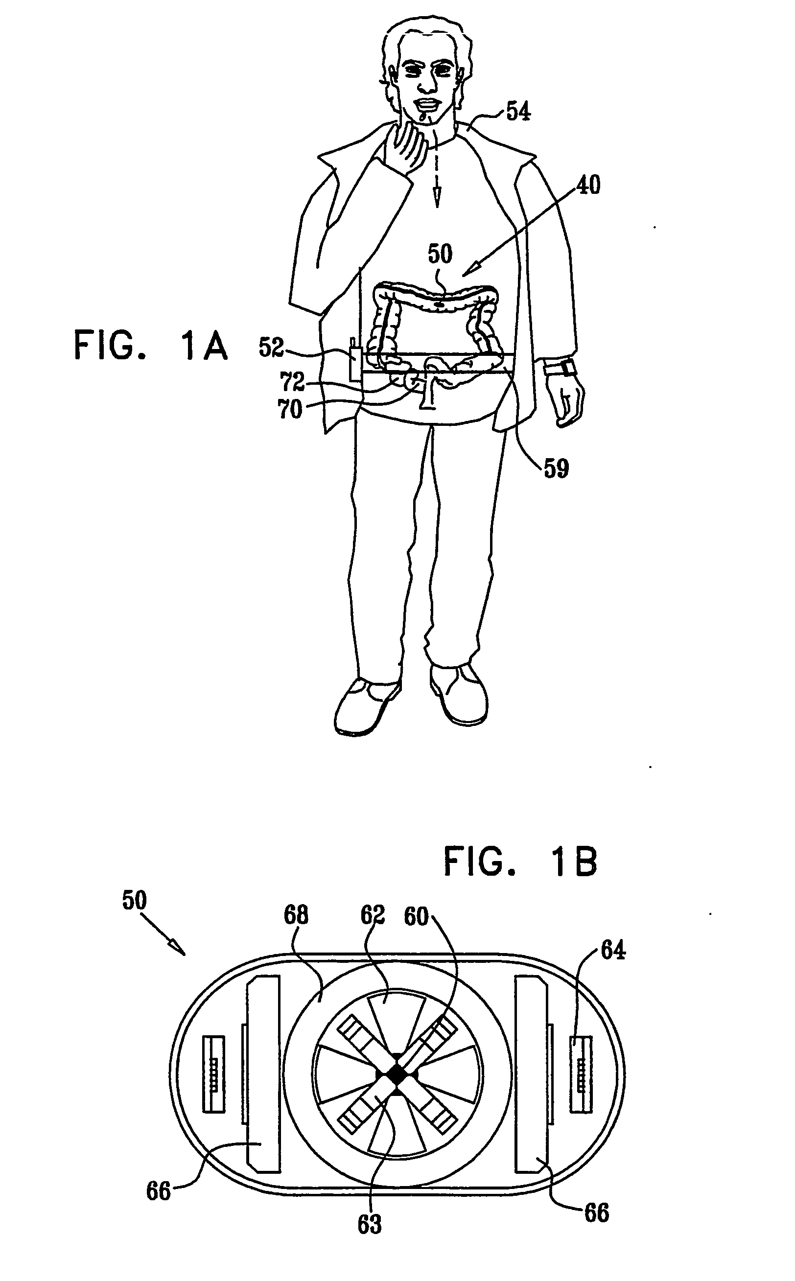 Intra-lumen polyp detection