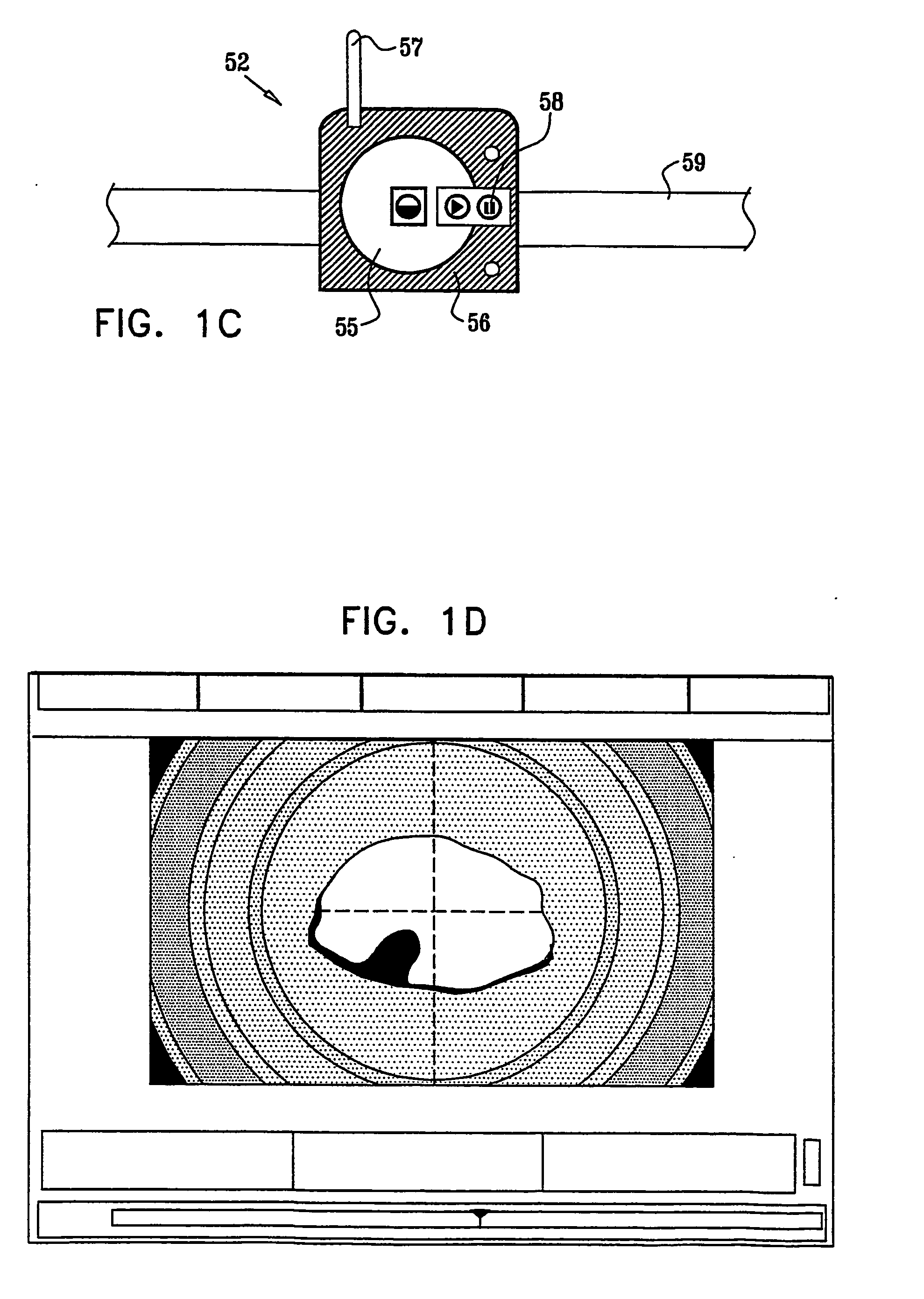 Intra-lumen polyp detection