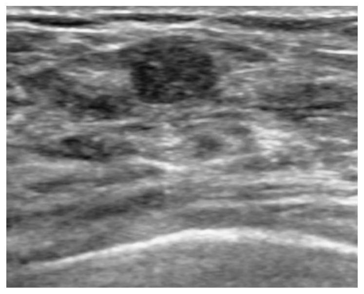 Ultrasonic Breast Tumor Morphological Quantification Feature Extraction Method Based on Shape Histogram