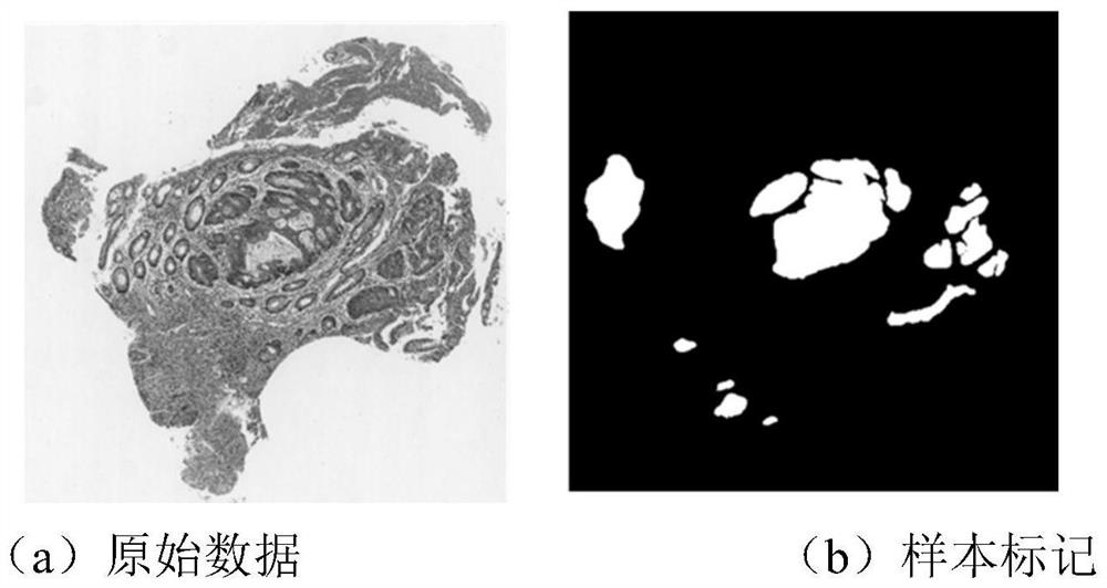 Colorectal cancer digital pathological image discrimination method and system based on weak supervised learning