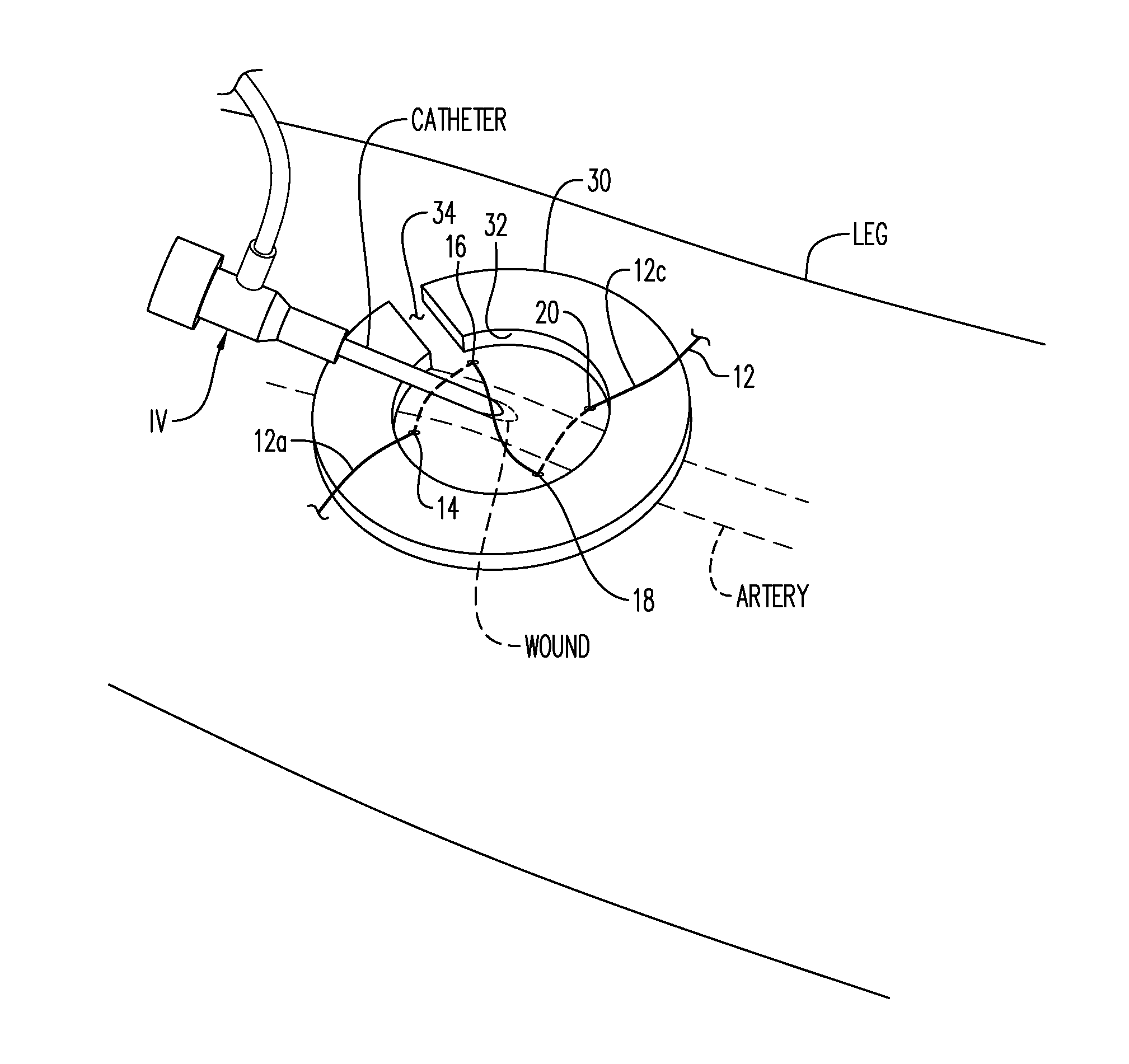 Vascular Access Wound Sealing System and Method