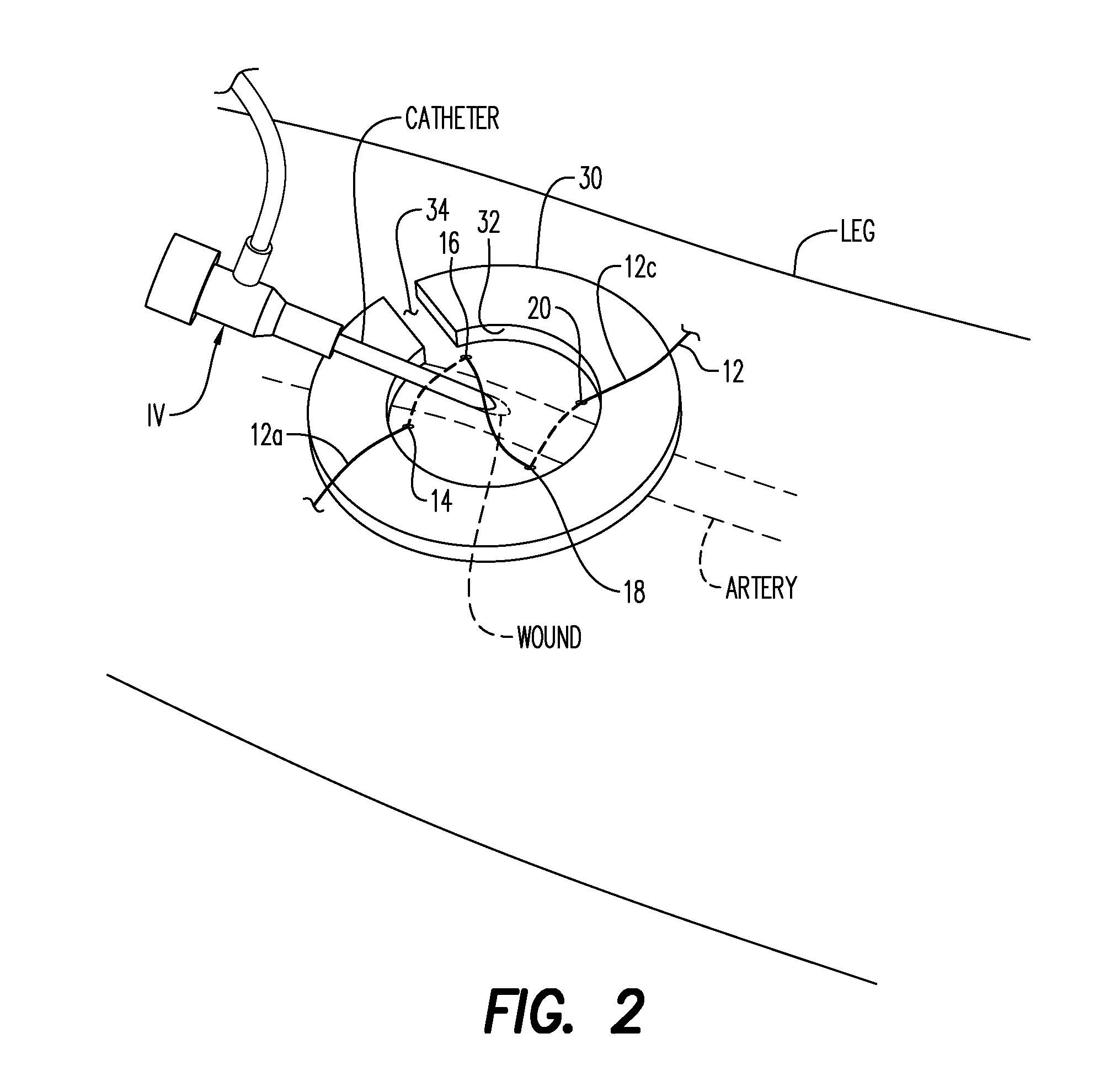 Vascular Access Wound Sealing System and Method