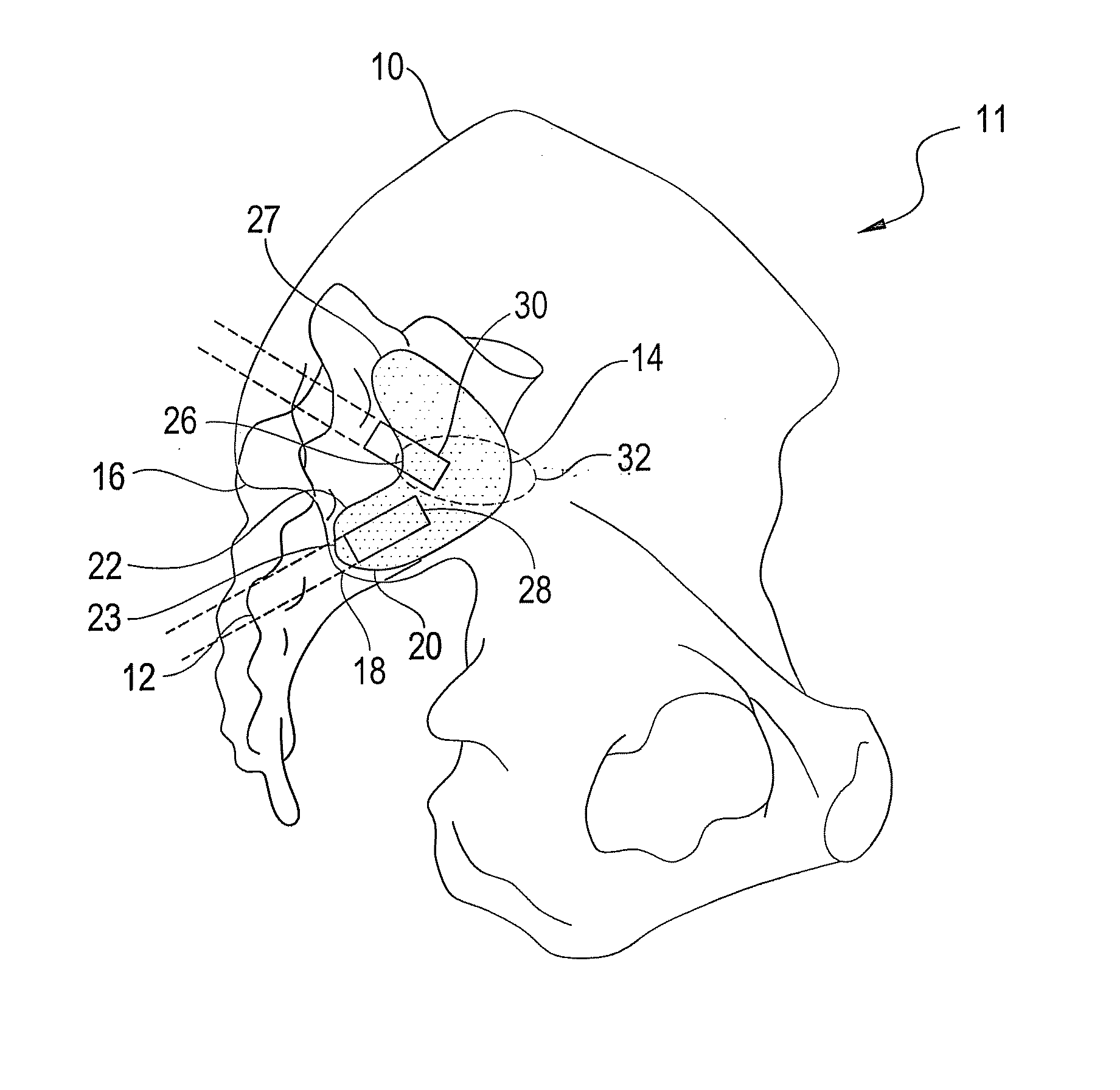 Sacroiliac joint stabilization method