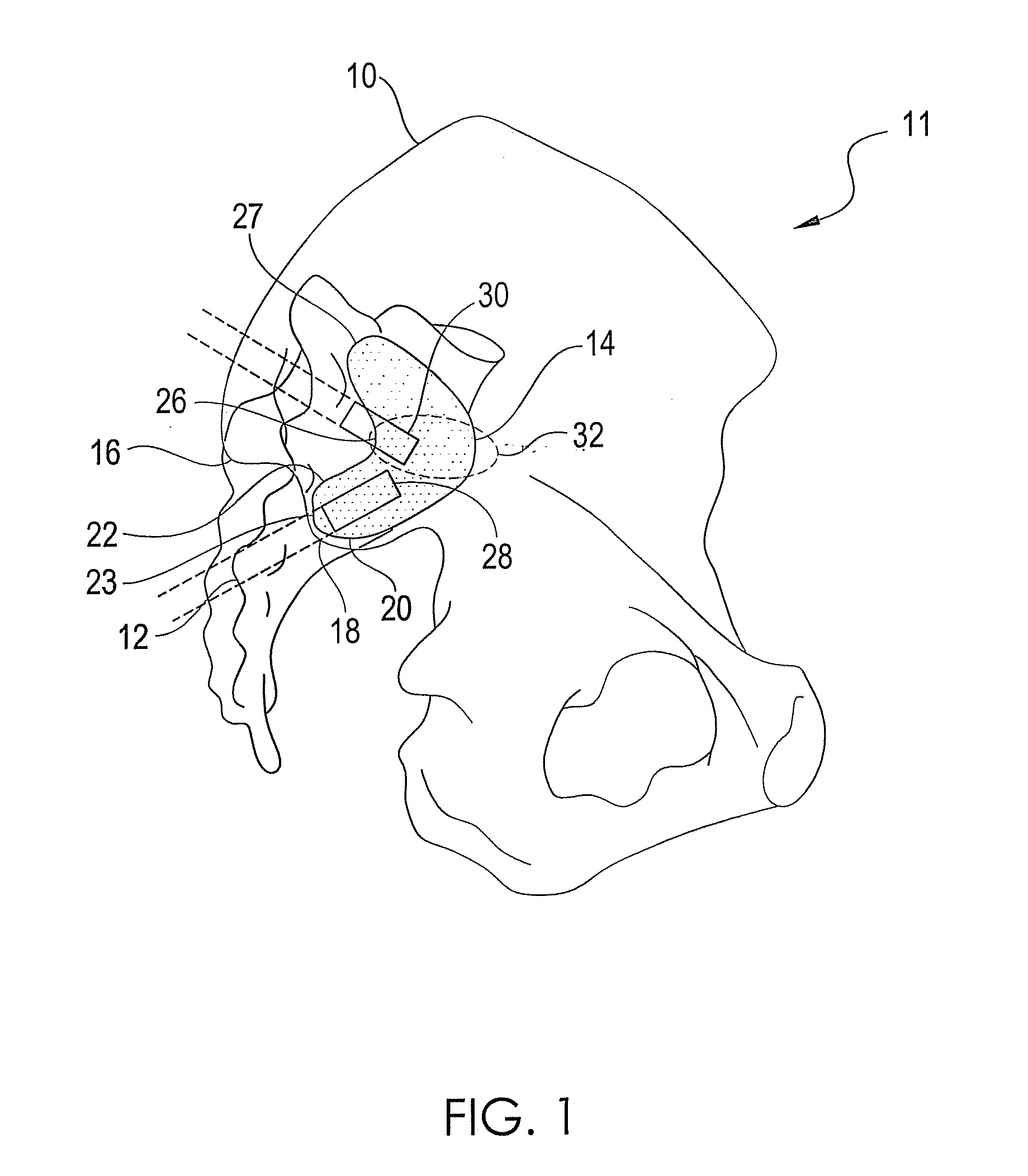 Sacroiliac joint stabilization method