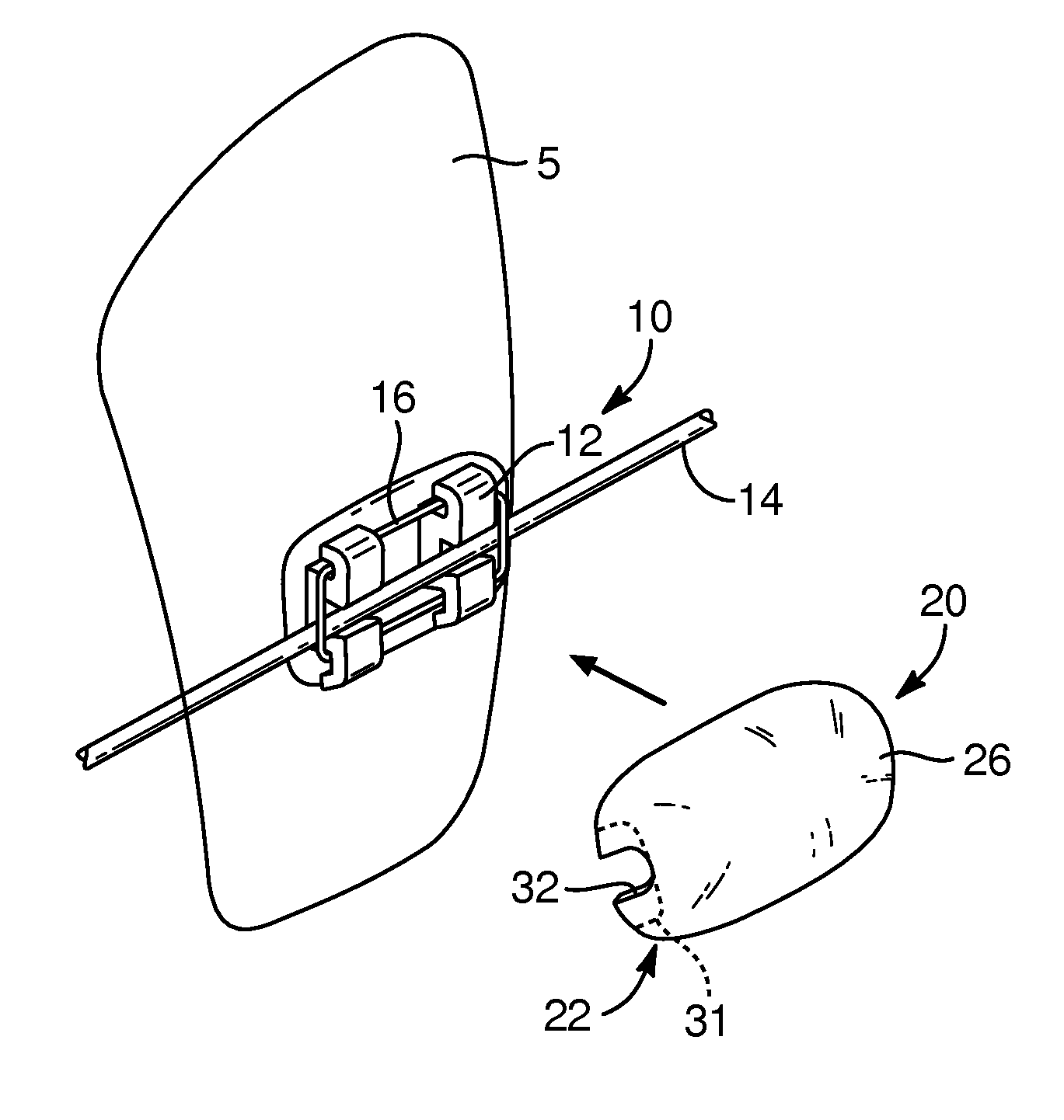 Devices, systems, and methods for orthodontic hardware