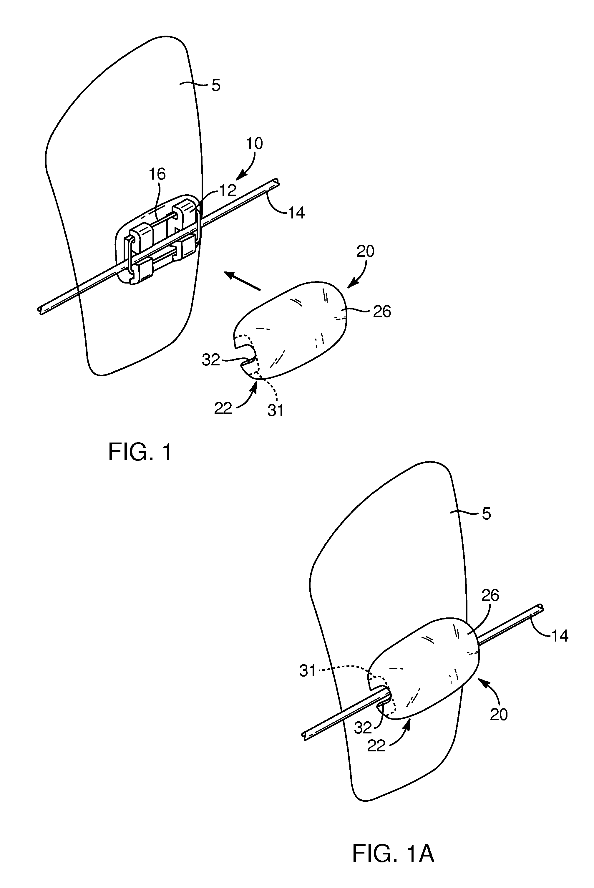 Devices, systems, and methods for orthodontic hardware