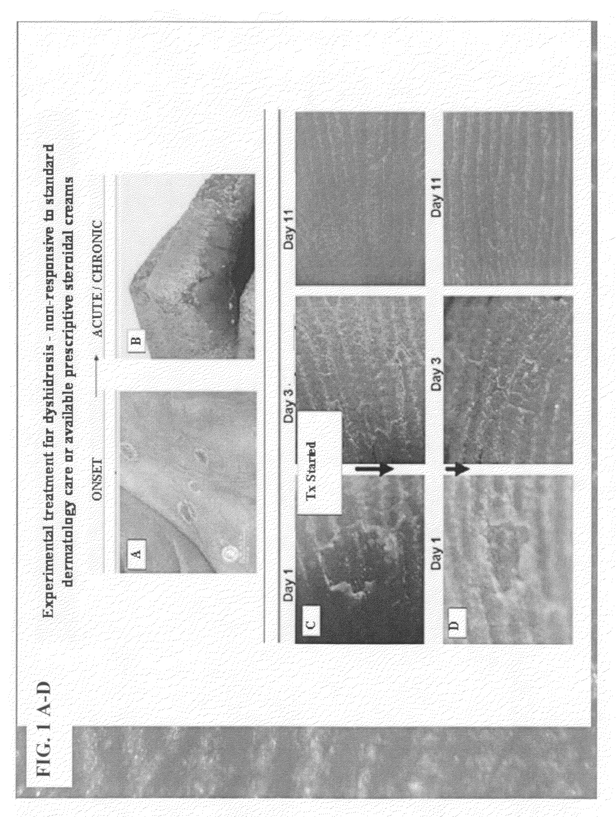 Method of treating dyshidrosis(pompholyx) and related dry skin disorders