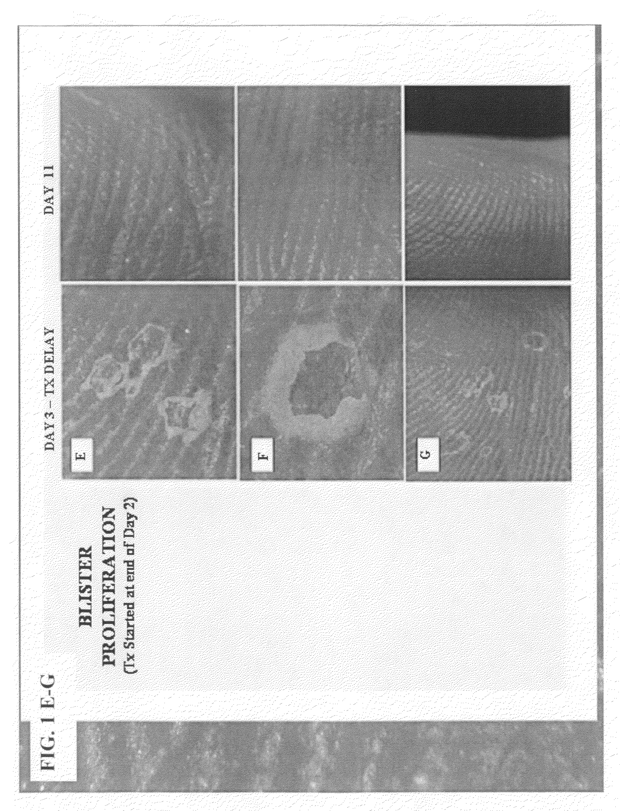 Method of treating dyshidrosis(pompholyx) and related dry skin disorders