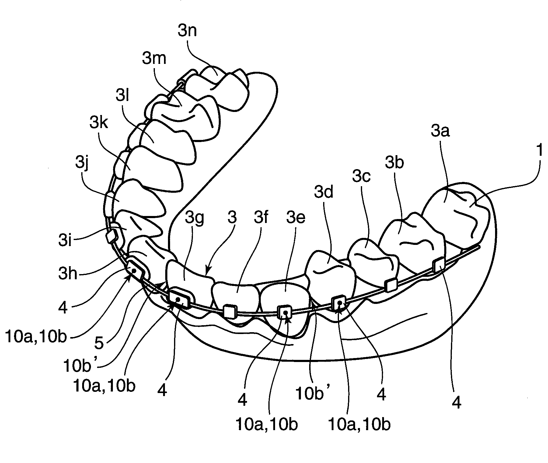 Orthodontic appliance