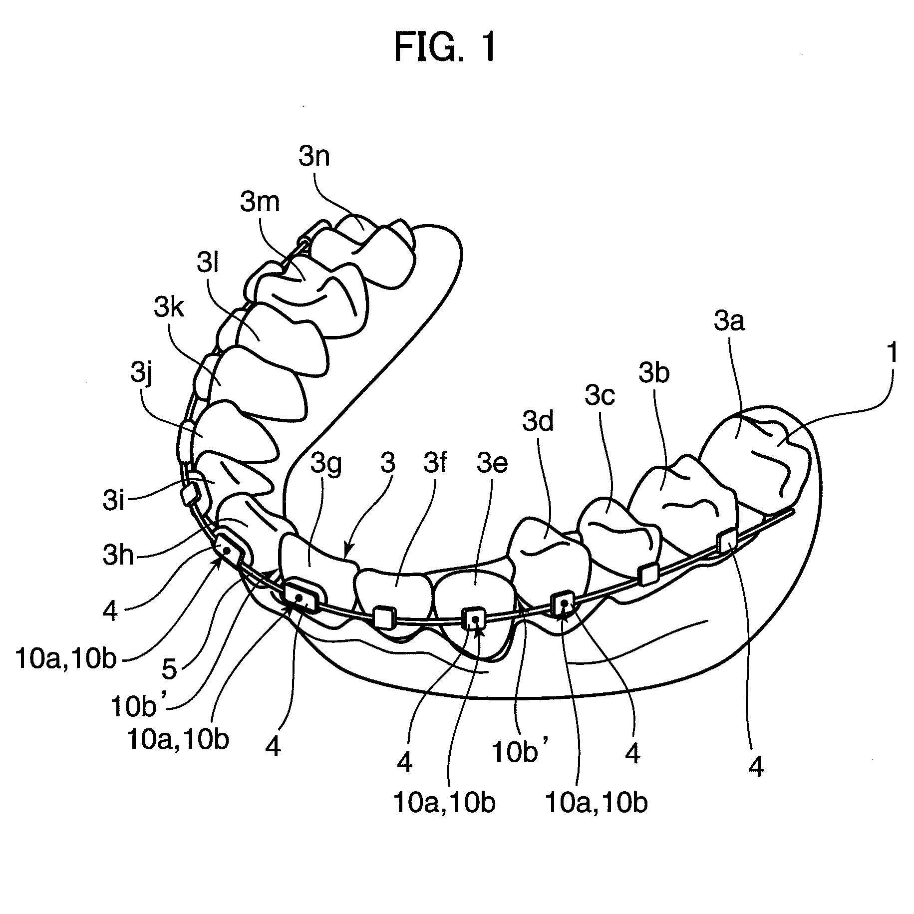 Orthodontic appliance