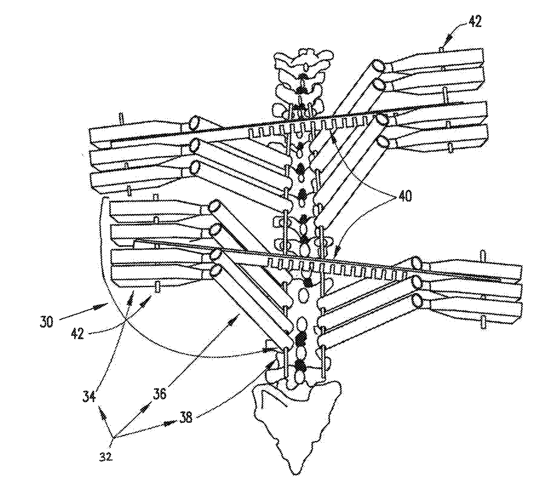 System and method for aligning vertebrae in the amelioration of aberrant spinal column deviation conditions