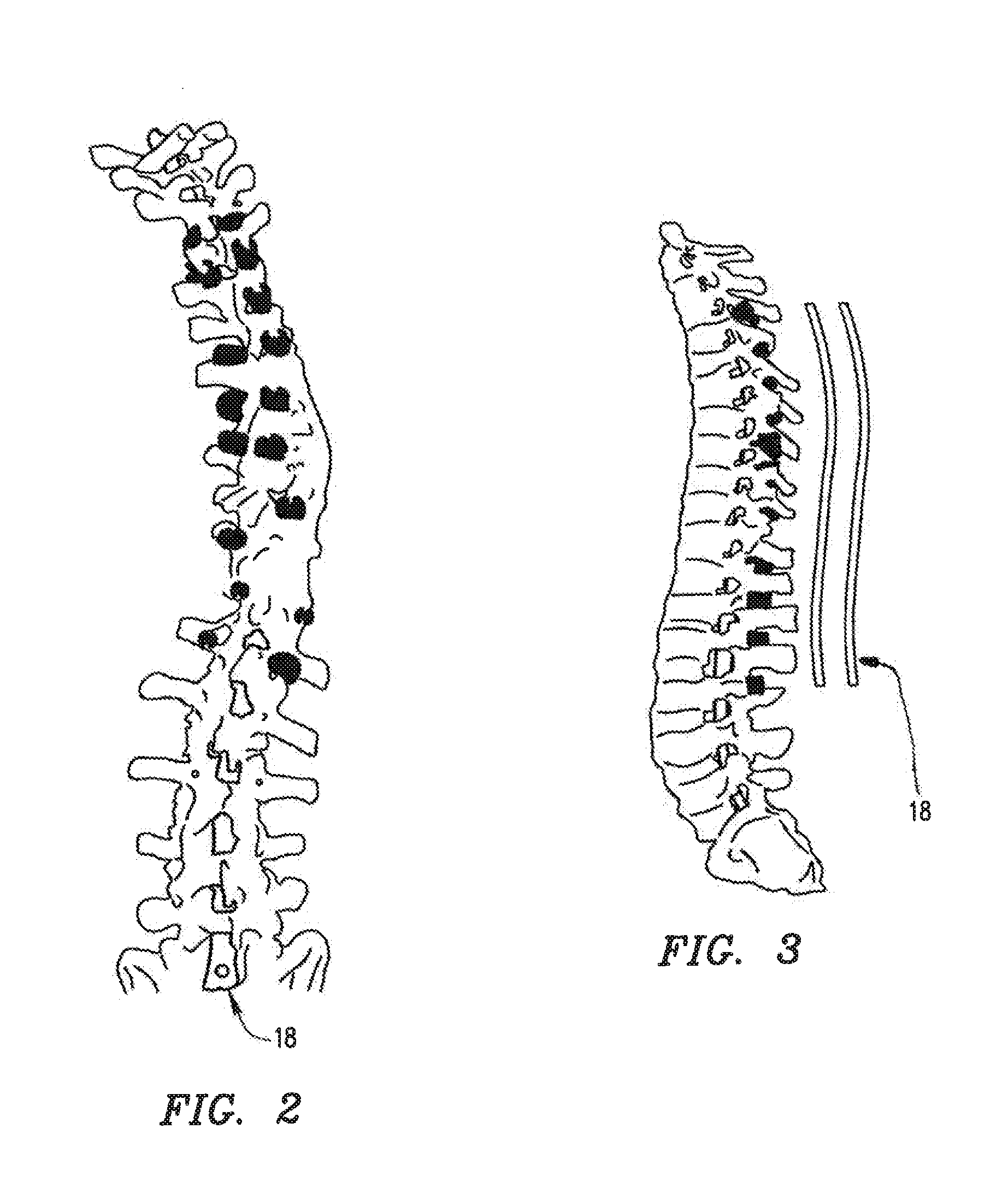 System and method for aligning vertebrae in the amelioration of aberrant spinal column deviation conditions