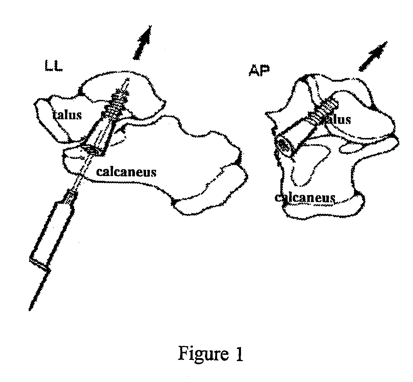 Canulated titanium implant for correcting flat feet in children