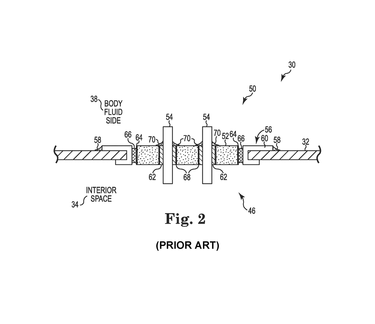 Direct integration of feedthrough to implantable medical device housing using a gold alloy