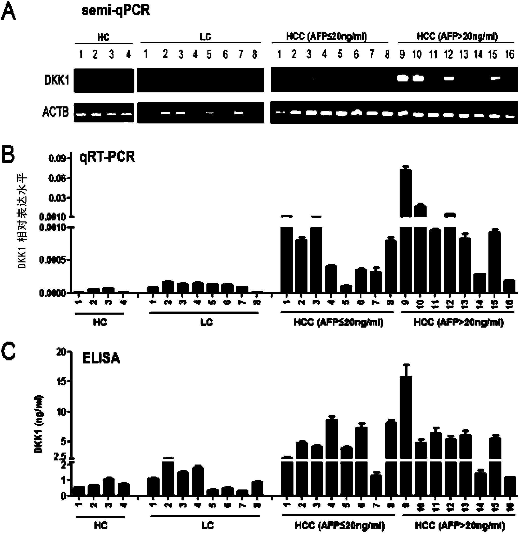 Application of serum DDK1 in preparation of diagnosis reagent for alpha fetal protein negative hepatocellular carcinoma