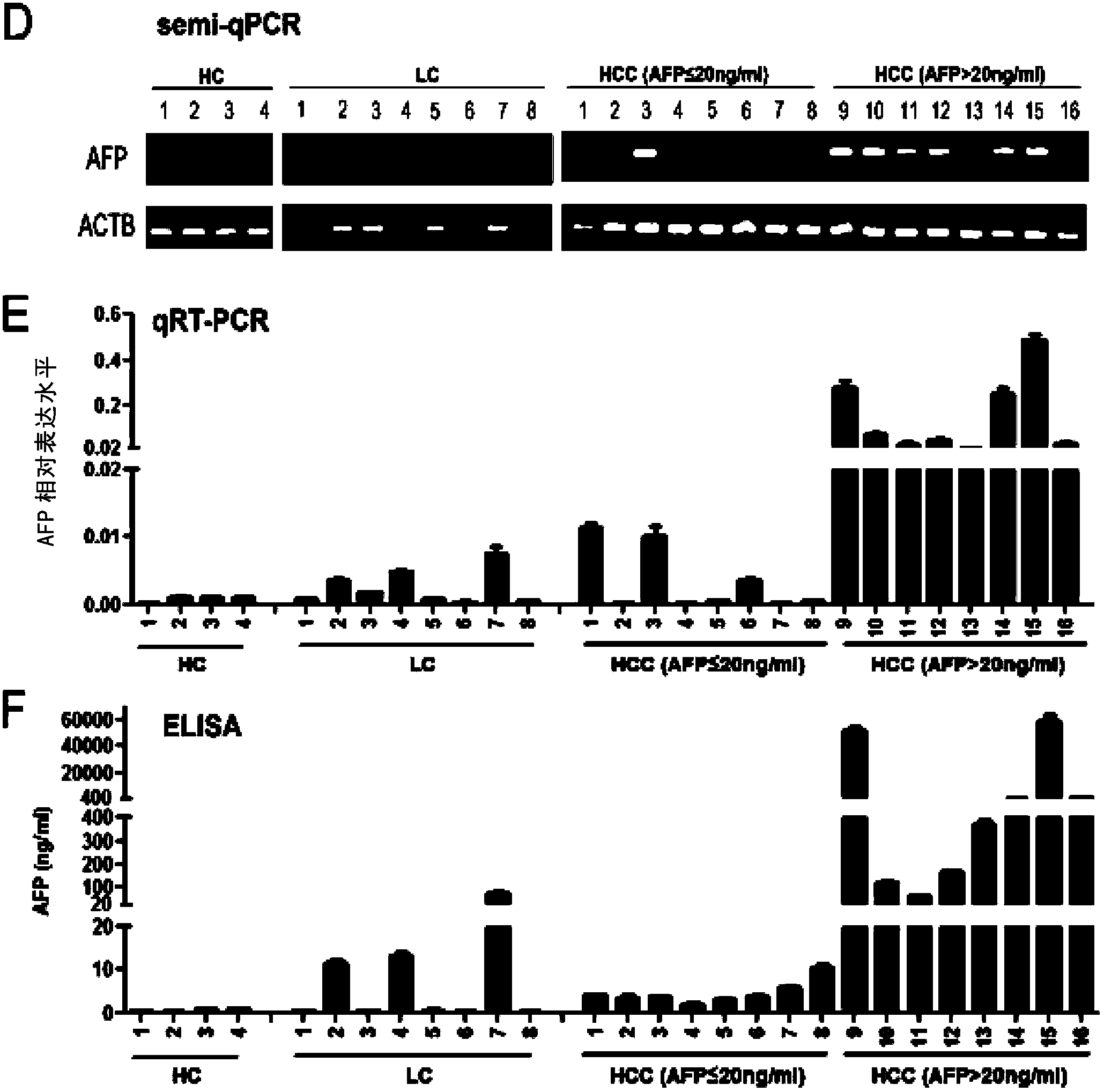 Application of serum DDK1 in preparation of diagnosis reagent for alpha fetal protein negative hepatocellular carcinoma