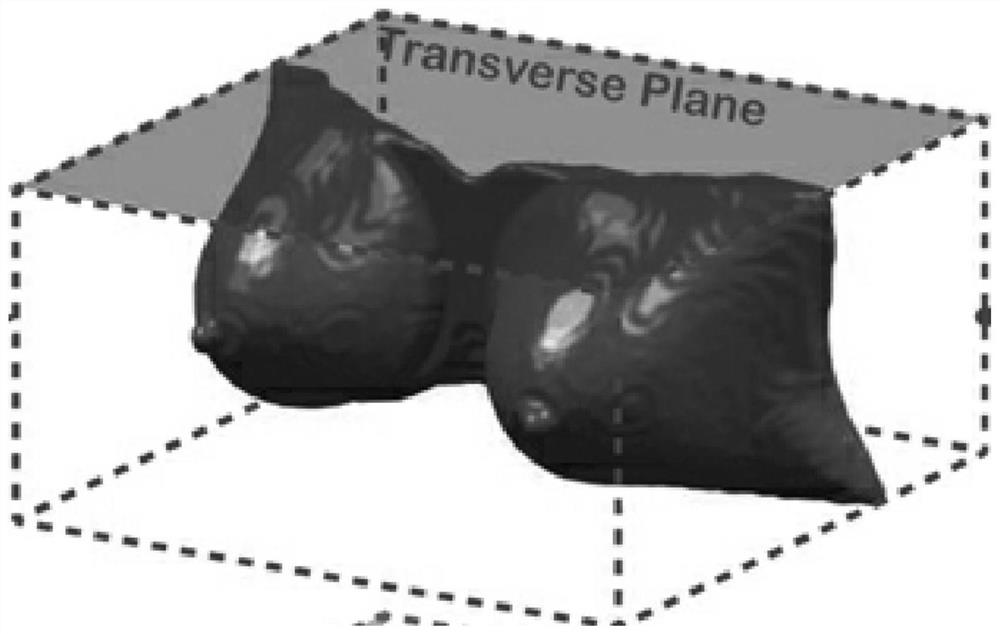 Improved mammary gland MRI segmentation method based on U-Net network